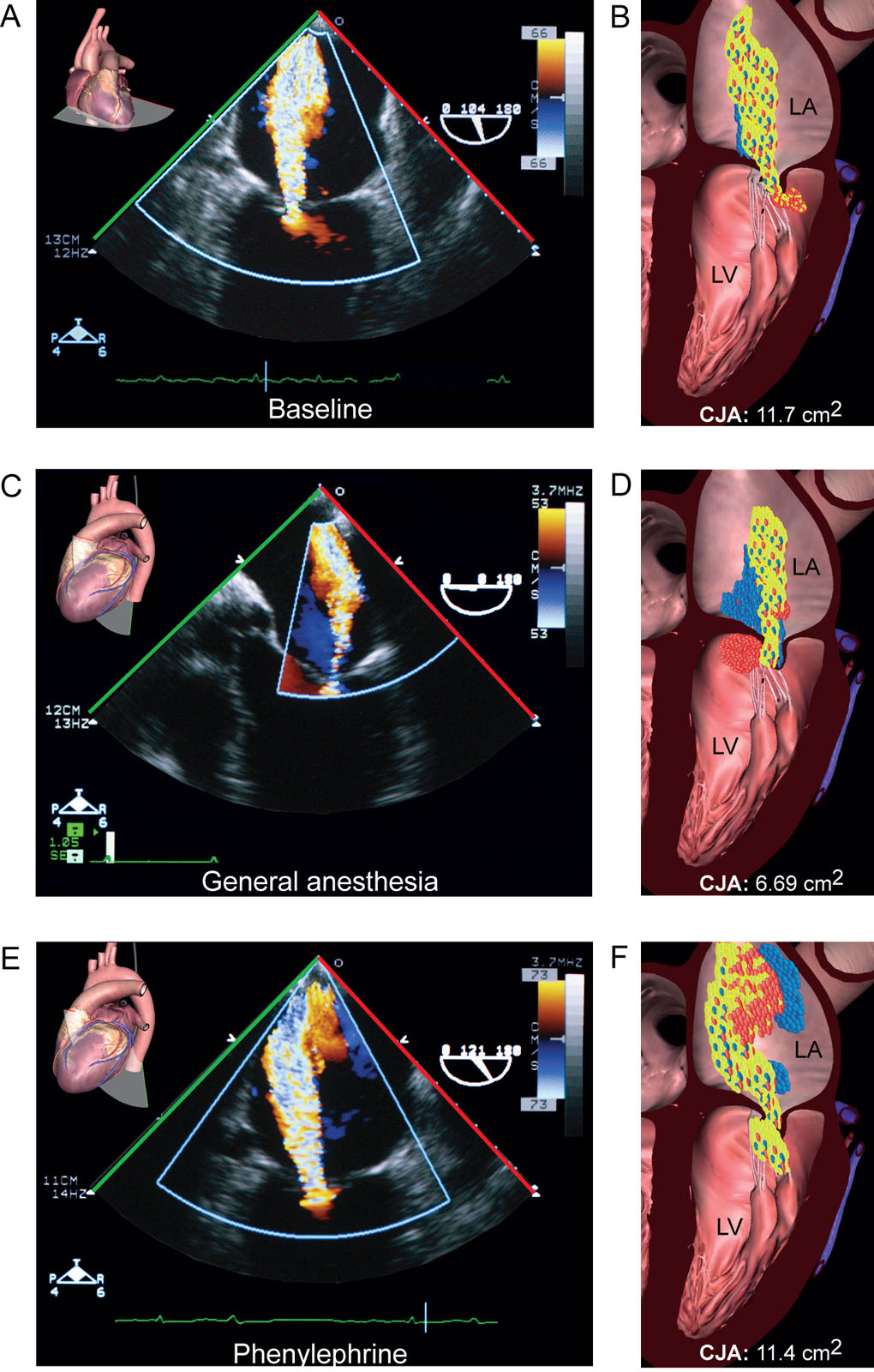 CFI jet area and general anesthesia. CFI jet areas appear from different ME views in a patient with MR during (A,B) awake baseline state. (C,D) after induction of general anesthesia and (E, F) using phenylephrine to obtain the same systolic arterial pressure (150 mmHg) as during baseline. Note the reduced CFI jet area during general anesthesia.<em> Abbreviations</em>: CFI, color flow imaging; CJA, color jet area; LA, left atrium; LV, left ventricle; ME, mid-esophageal; MR, mitral regurgitation. Adapted from Gisbert et al.<strong><sup>41</sup></strong>