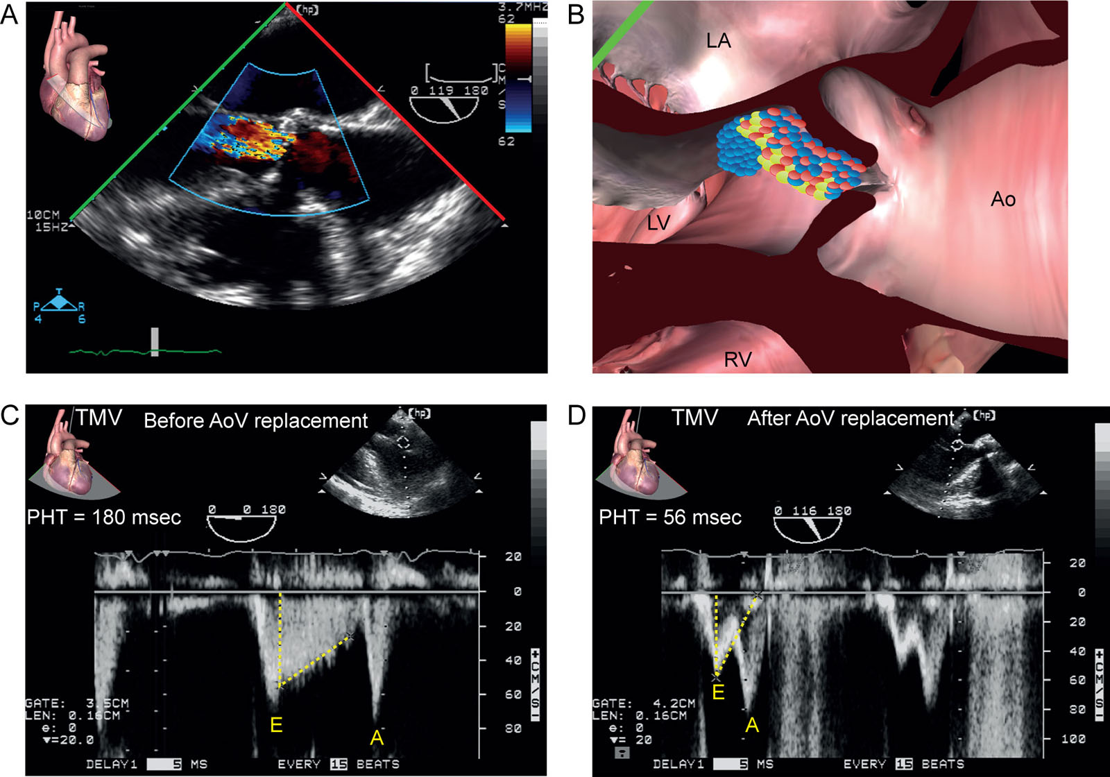 Pseudo MV stenosis. (A, B) ME AoV LAX view with CFI view in a 78-year-old woman scheduled for AoV replacement. (C) The AoV regurgitation was associated with a pseudo MS CWD pattern from either restricted opening of the MVAL or contamination from the AoV regurgitation signal. The PHT obtained from the Doppler TMV was 180 ms compared with (D) 56 ms after AVR.<em> Abbreviations</em>: A, peak late diastolic TMV; Ao, aorta; AoV, aortic valve; AVR, aortic valve replacement; CFI, color flow imaging; CWD, continuous wave Doppler; E, peak early diastolic TMV; LA, left atrium; LAX, long-axis; LV, left ventricle; ME, mid-esophageal; MS, mitral stenosis; MS, mitral stenosis; MV, mitral valve; MVAL, mitral valve anterior leaflet; PHT, pressure half-time; RV, right ventricle; TMV, transmitral velocity. <i class='fa fa-video-camera' aria-hidden='true'></i>
