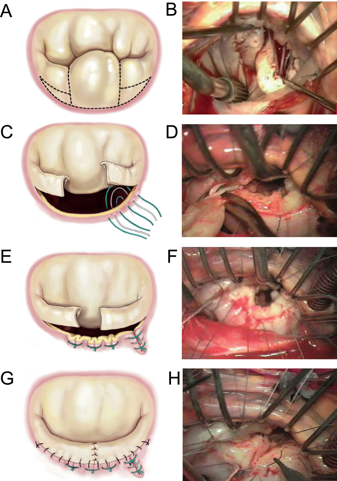 MV repair in Barlow’s disease. These diagrams and intraoperative photos show a complex MV repair of (A, B) P2 prolapse that includes the (C, D) resection line for quadrangular resection and leaflet sliding plasty, (E, F) vertical compression and the (G, H) completed suture lines. Abbreviation: MV, mitral valve. Adapted from Chikwe et al. <strong><sup>18</sup></strong>Photos courtesy of Dr. Michel Pellerin. <i class='fa fa-video-camera' aria-hidden='true'></i>