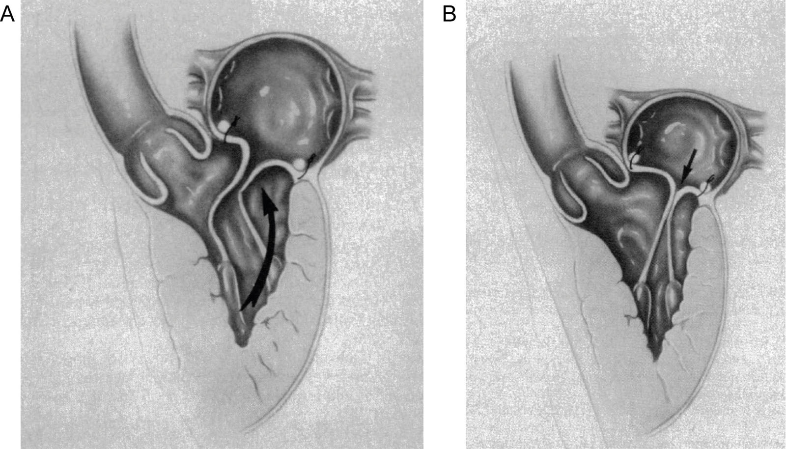 Sliding technique. (A) An inadequate repair will result in LV flow closing the posterior leaflet, which pushes the anterior leaflet toward the LVOT. (B) The sliding leaflet technique reduces the posterior leaflet height so the anterior leaflet closes away from the LVOT. Abbreviation: LV, left ventricle; LVOT, left ventricular outflow tract. With permission from Jebara et al.<strong><sup>19</sup></strong>