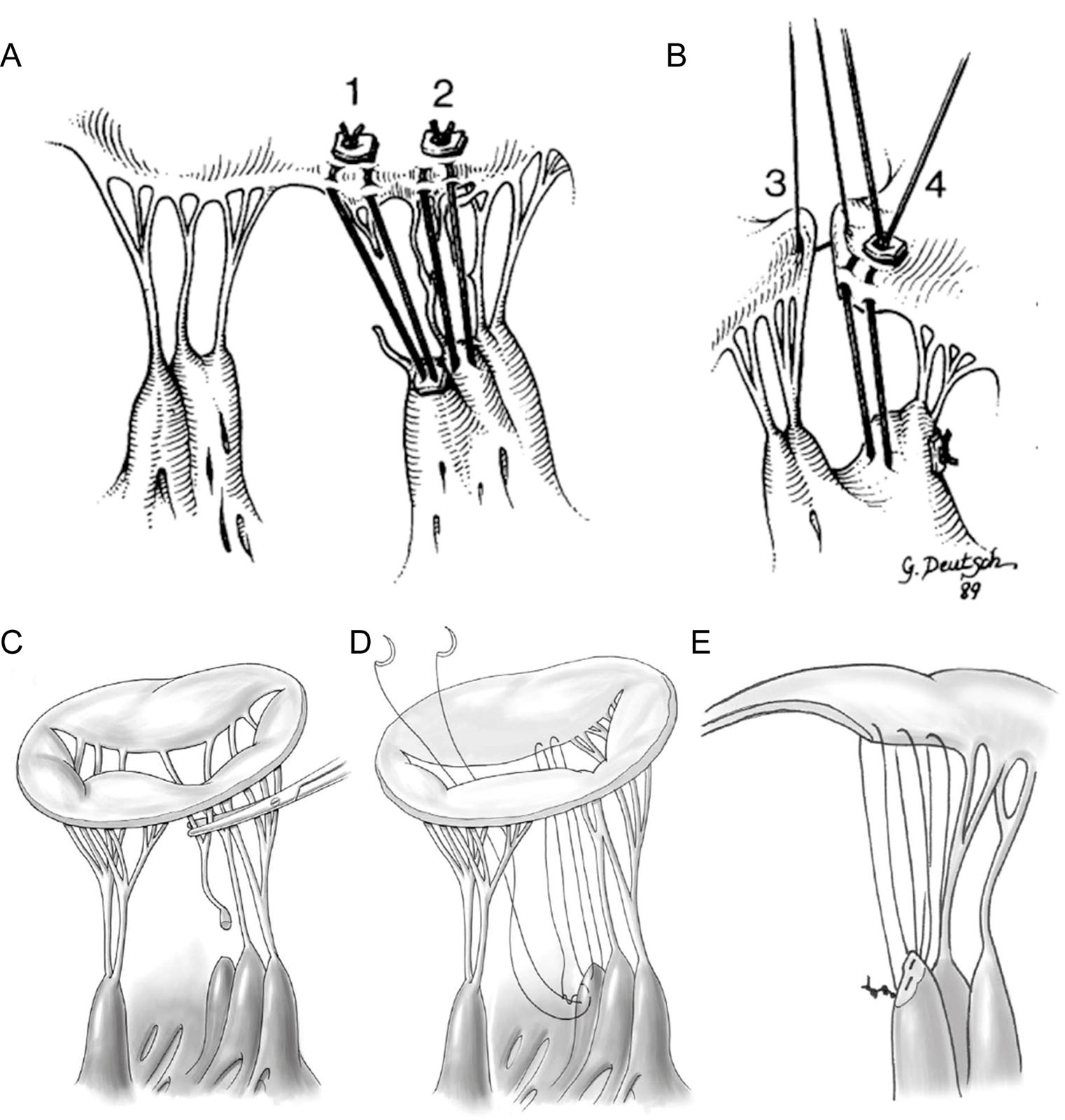 Chordal repair techniques. (A) Replacement for anterior chordae rupture and elongation. (#1), replacement of the ruptured main chorda to medial side of anterior cusp. Extruded PTFE suture is tied at the papillary level on a pledget. At the cusp, the suture has been passed through the thickened free edge and tied over a piece of autogenous pericardium; (#2), attenuated, elongated, paramedial chordae have been judged too thin for shortening. Furthermore, the papillary muscle is sessile. Another pair of new chordae function for these. An alternative papillary technique with a pledget on one side only is used. (B) Length is adjusted so that opposing free edges are parallel with the chordae under tension. (#3), a temporary suture is pulled to keep the chordae taut while the chordae are tied (#4). (C-E) Operative technique to replace ruptured chordae tendineae with Gore-Tex sutures. A single suture is successively passed through the papillary muscle and free margin of the leaflet to create several pairs of artificial chordae.<em> Abbreviations</em>: PTFE, polytetrafluorethylene. Adapted from Frater <strong><sup>20</sup></strong> and David <strong><sup>21</sup></strong>.