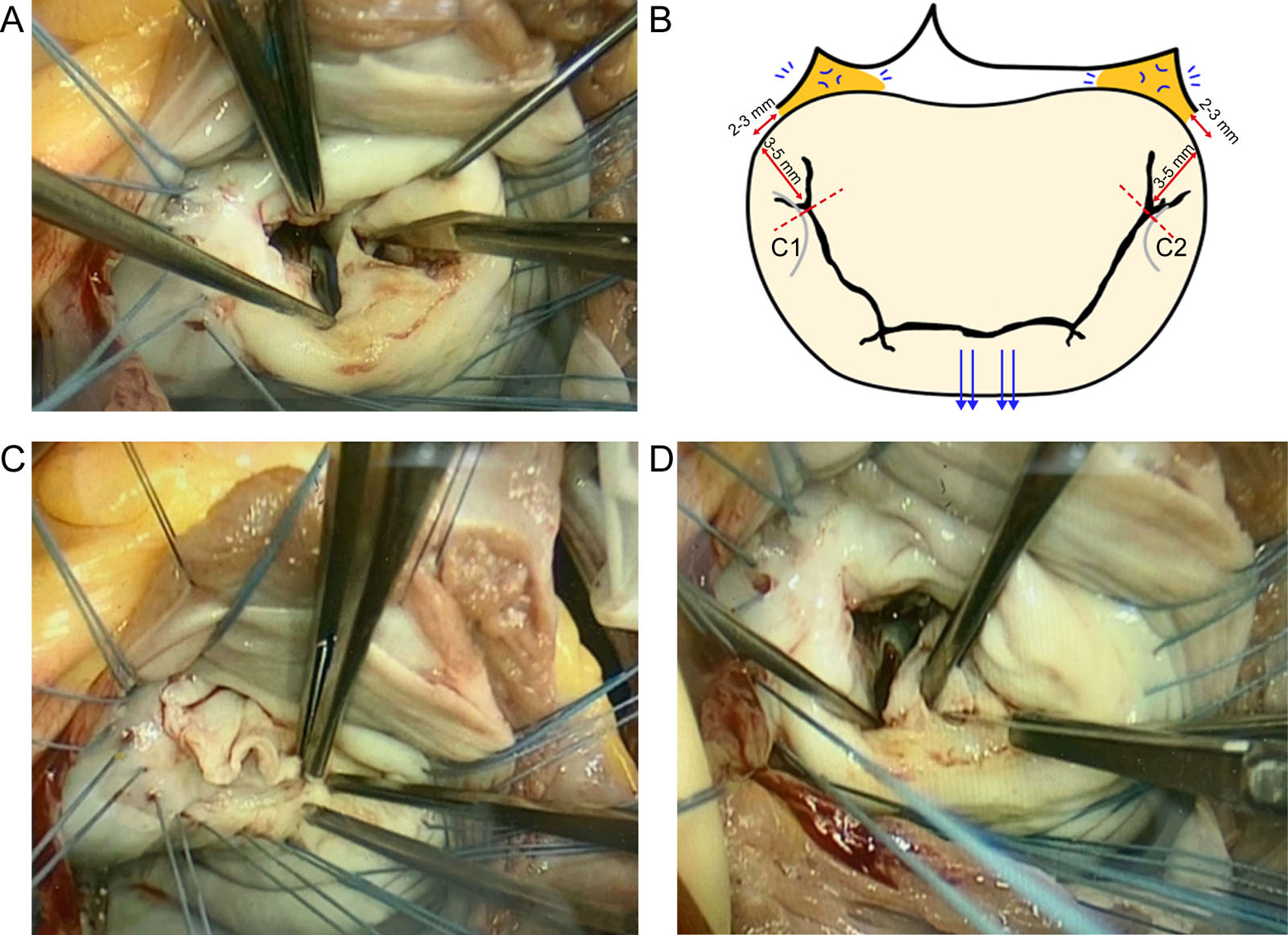 Rheumatic valvular disease repairs. (A) Intraoperative antero-lateral commissurotomy being performed. (B) Schematic illustration of how commissurotomy is performed in Bristol, UK. The blue arrows depict symmetrical traction on the AMVL perpendicular to the inter-trigonal line, which creates dimpling, depicted by the blue markings, subsequently identifying the trigones (orange zones). Red dotted line: ideal point up to which commissurotomy should be performed, stopping 3-5 mm from the annulus and 2-3 mm laterally from the trigone (red bars). (C) Leaflet peeling and (D) posterior mitral leaflet fenestration and chordal resection. Abbreviation: AMVL, anterior mitral valve leaflet. Adapted from Dejsupa et al.<strong><sup>27</sup></strong>