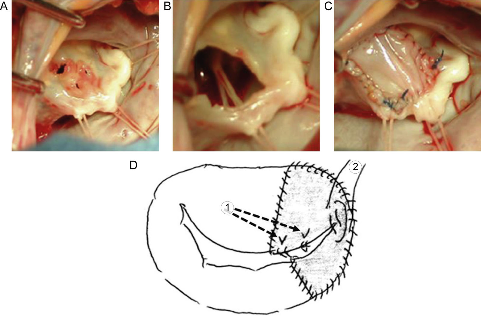 MV repair for infective endocarditis. These are intraoperative photos showing repair of the AMVL in a patient with endocarditis. (A) There are perforations of the AMVL requiring (B) resection of a portion of the AMVL. (C) Repair of the AMVL uses a patch closure of autologous pericardium. (D) Leaflet reconstruction using autologous pericardium and PTFE suture (*1: chordal reconstruction. *2: magic stitch to make a good coaptation).<em> Abbreviations</em>: AMVL, anterior mitral valve leaflet; MV, mitral valve; PTFE, polytetrafluorethylene. Adapted from Okada et al.<strong><sup>30</sup></strong>