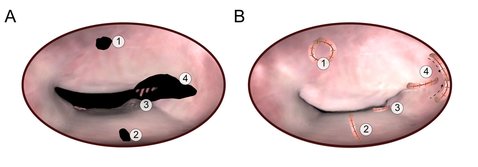 MV repair for infective endocarditis. These diagrams show different options for MV repair in endocarditis. (A) AMVL perforation treated by pericardial patch closure and PMVL quadrangular resection. (B) Pericardial patch replacement of almost the entire AMVL. (C) Chordal transposition from the PMVL to the free edge of the AMVL. (D) Sliding commissuroplasty for a prolapse of both AMVL and PMVL in the para-commissural area.<em> Abbreviations</em>: AMVL, anterior mitral valve leaflet; MV, mitral valve; PMVL, posterior mitral valve leaflet. Adapted from Dreyfus et al.<strong><sup>31</sup></strong>