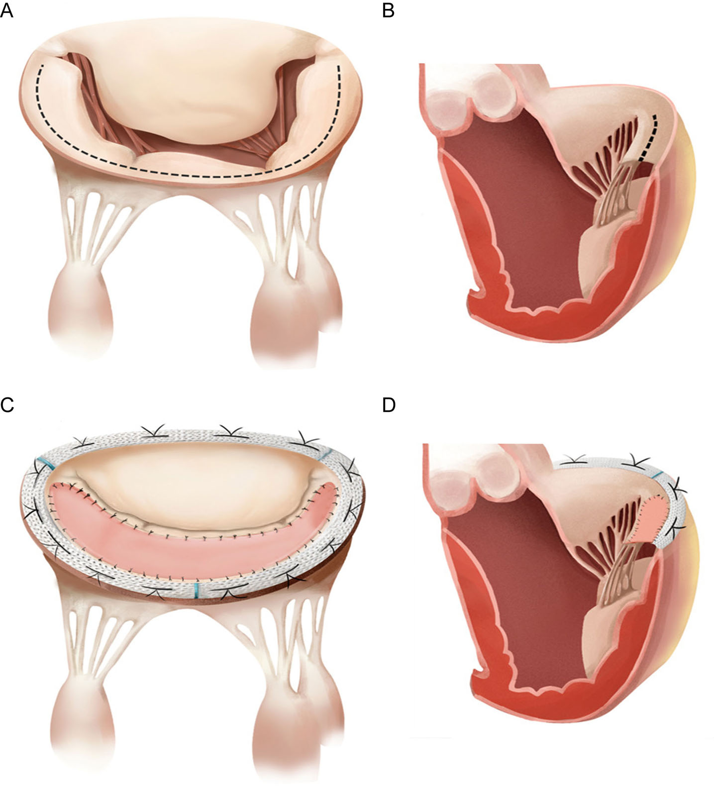 Secondary MR surgical approach. PMVL patch augmentation with true‐sized annuloplasty in patients with severe ischemic MR due to significant PMVL (i.e., P3) tethering. (A,B) A commissure‐to‐commissure incision is made along the posterior mitral annulus (the dashed line). (C,D) A CardioCel patch slightly larger than the space area succeeding the “fall” of the PMVL (whereas deferring to its shape and curvature) is prepared and sutured on the leaflet, followed by a true‐sized semirigid ring annuloplasty.<em> Abbreviations</em>: MR, mitral regurgitation; PMVL, posterior mitral valve leaflet. Adapted from Hu et al.<strong><sup>102</sup></strong>