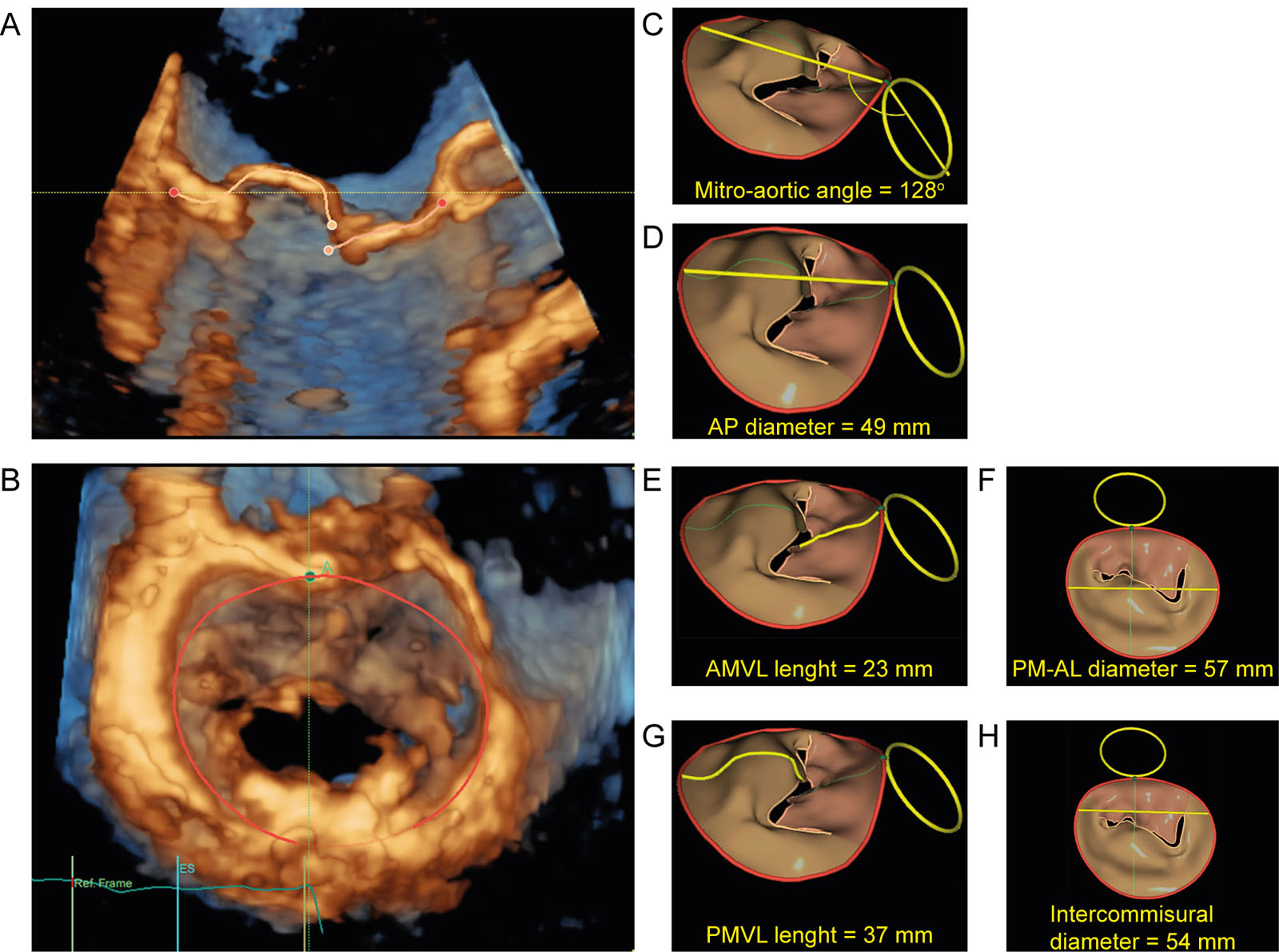 3D MV model measurements. (A, B) This is a 3D MV model obtained after computer analysis of 3D MV dataset which automatically gives measures of (C) mitro-aortic angle, (D) AP annulus diameter, (E )AMVL length, (F) PM-AL annulus diameter (G) PMVL length and (H) inter-commissural diameter.<em> Abbreviations</em>: 3D, three-dimensional; AL, antero-lateral; AMVL, anterior mitral valve leaflet; AP, antero posterior; MV, mitral valve; PM, postero-medial; PMVL, posterior mitral valve leaflet. (GE HealthCare, USA)
