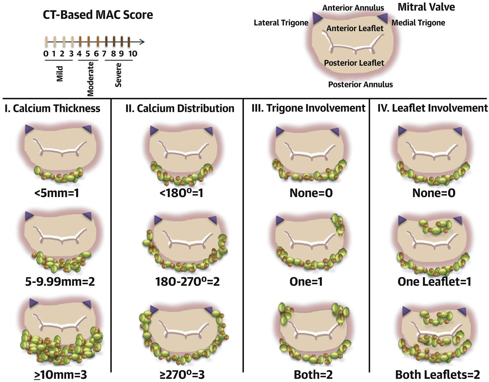 MAC score. These diagrams illustrate the components of the MAC score and their corresponding points, including (I) average annulus calcium thickness, (II) calcium distribution in annulus circumference (III) trigone calcification and (IV) mitral leaflet calcification. A severity grade based on the total points accumulated as follows: mild MAC = 3 points or less, moderate MAC = 4 to 6 points, and severe MAC ≥ 7 points.<em> Abbreviations</em> CT, computed tomography; MAC, mitral annular calcification. Adapted from Guerrero et al.<strong><sup>52</sup></strong>