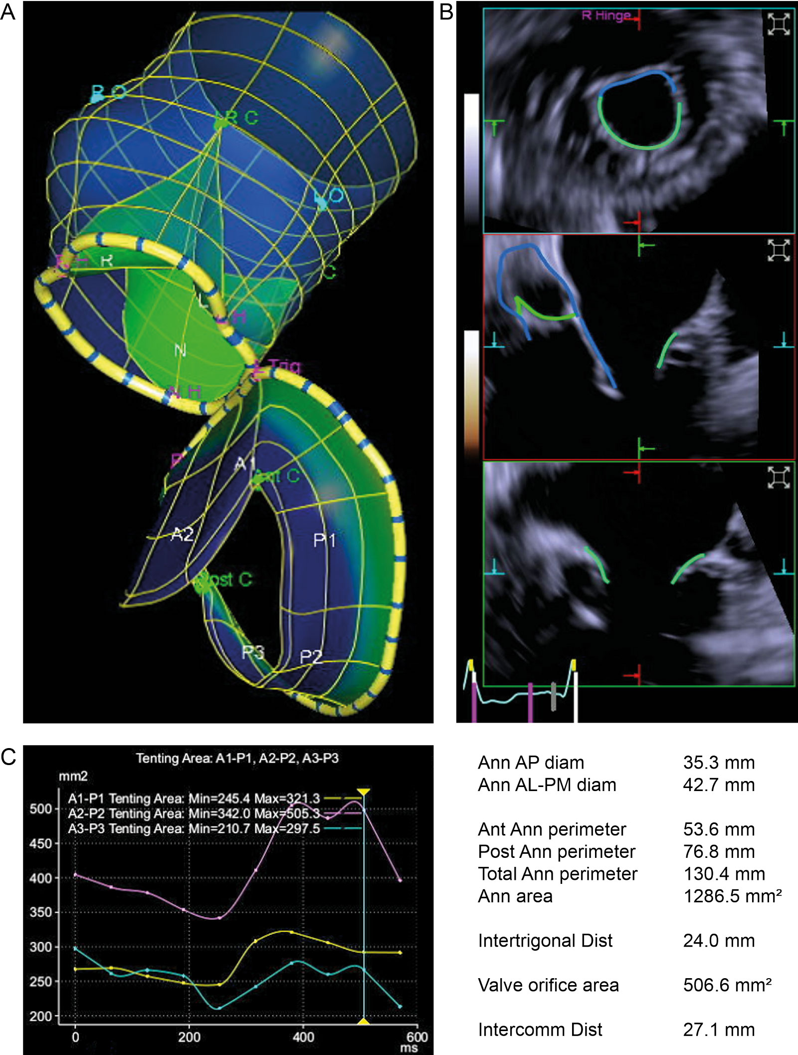 AoV and MV 3D model. (A) This is an example of software analysis of a 3D dataset of the AoV and MV, which creates a single dynamic model. (B) The model automatically measures AoV and MV area, MV leaflet length and tenting area. (C) The measurements appear in graphic and numeric forms and can change during the cardiac cycle.<em> Abbreviations</em>: 3D, three-dimensional; AL, antero-lateral; Ann, annular; Ant, anterior; AoV, aortic valve; AP, anterior-posterior; Dist, distance; MV, mitral valve. (Siemens Healthinieers, Erlangen, Germany). <i class='fa fa-video-camera' aria-hidden='true'></i>