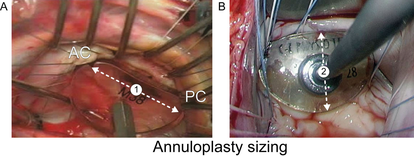 Annuloplasty ring sizer. This illustration shows the different options for using the manufacturer’s sizer to determine the annuloplasty ring size. (A) Sizer notches for measuring either the inter-trigonal or inter-commissural distance (#1). (B) Area of the sizer to determine entire area of MV or bare area if anterior leaflet. The height measurement of the anterior leaflet (#2) is shown.<em> Abbreviations</em>: AC, anterior commissure; MV, mitral valve; PC, posterior commissure. Modified from Bothe et al. <strong><sup>62</sup></strong>