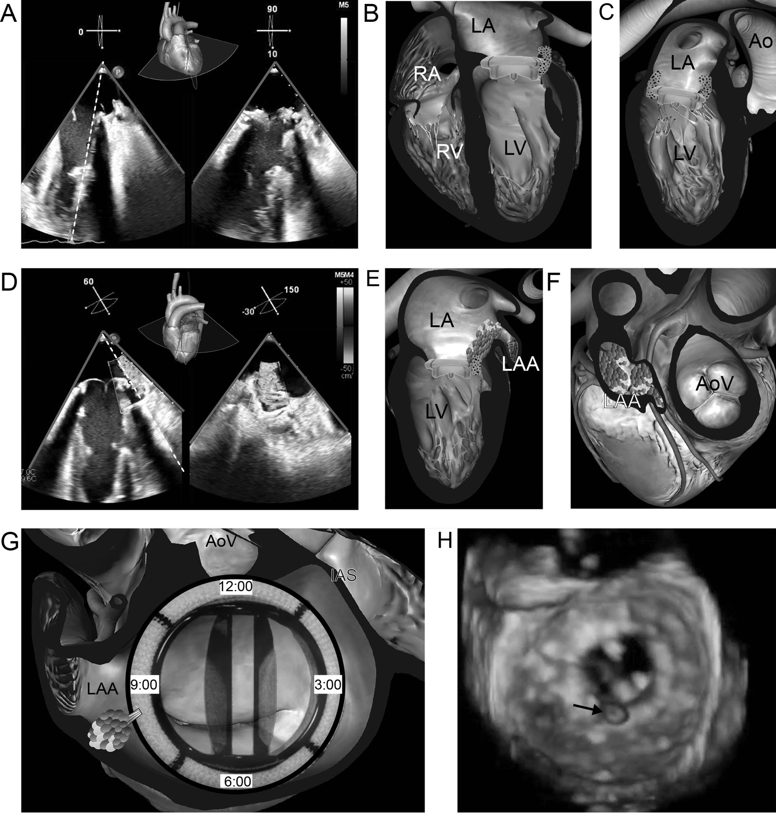 Bioprosthesis endocarditis. (A-C) Biplane ME 4C view shows abnormal leaflet irregular thickening (arrows) suggestive of vegetations. (D-F) Biplane ME 60° view with CFI shows valve dehiscence with regurgitation (arrows) extending into the LAA. (G) The location of the paravalvular leak is around 9 o’clock near the LAA ostium. (H) 3D view from the LA perspective of the prosthesis shows mobile vegetation (arrow).<em> Abbreviations</em>: 3D, three-dimensional; 4C, four-chamber; Ao, aorta; AoV, aortic valve; CFI, color flow imaging; LA, left atrium; LAA, left atrial appendage; LV, left ventricle; ME, mid-esophageal; RA, right atrium; RV, right ventricle. <i class='fa fa-video-camera' aria-hidden='true'></i>