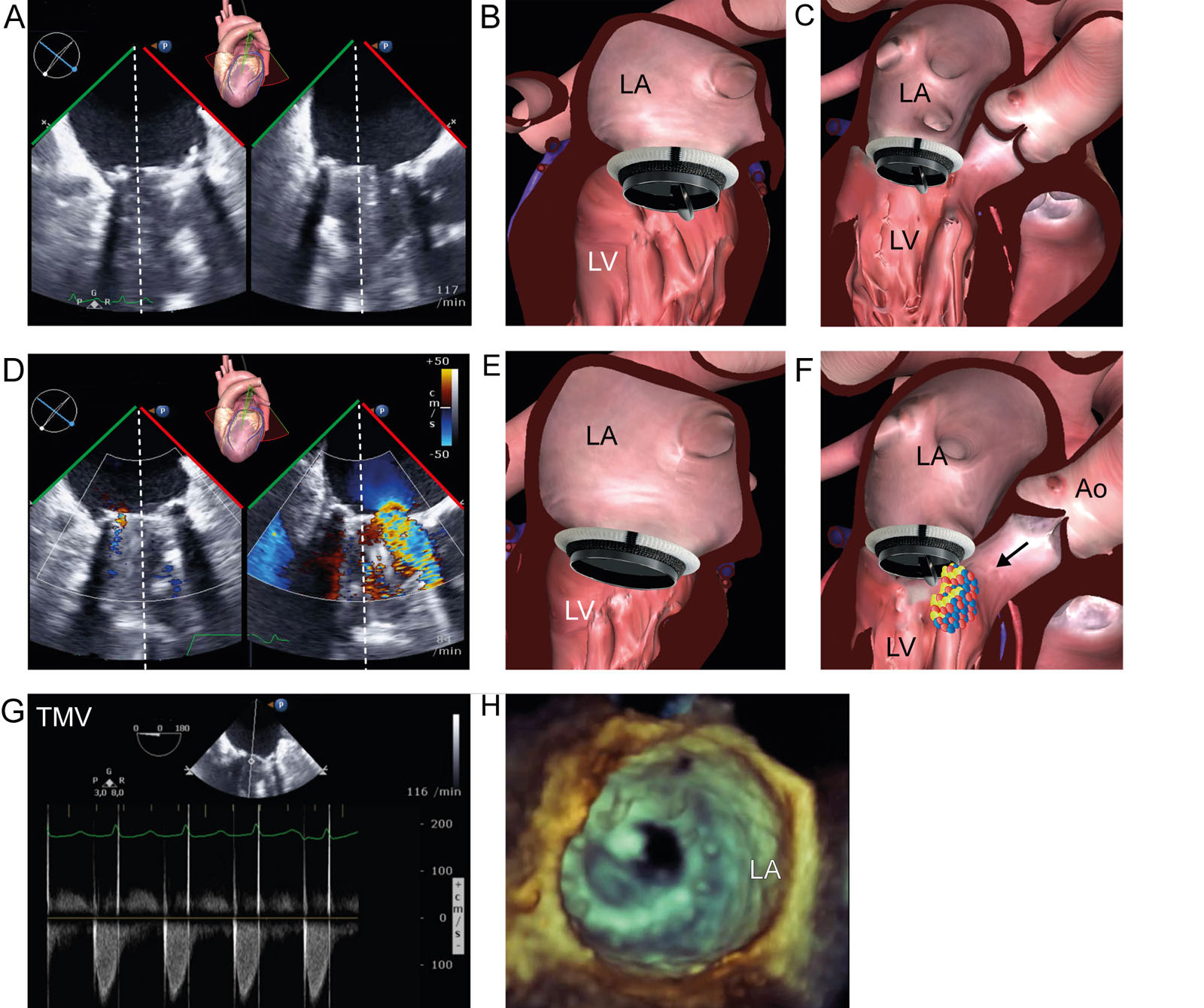 Prosthetic valve dysfunction. Bileaflet mechanical mitral valve prosthesis dysfunction. (A-C) Biplane ME MC view shows a bileaflet mechanical MV prosthesis during diastole with the posterior hemi-disc stuck in the closed position (arrows) 4 years after implantation. (D-F) Color compare ME MC view with CFI shows the stuck hemi-disc in the closed position with accelerated flow velocities across the other hemi-orifice. (G) CWD across the MV has an elevated diastolic gradient indicative of mitral stenosis. (H) 3D LA view of the mechanical MV prosthesis from the LA perspective confirms the stuck hemi-disc.<em> Abbreviations</em>: 3D, three-dimensional; Ao, aorta; CFI, color flow imaging; CWD, continuous wave Doppler; LA, left atrium; LV, left ventricle; MC, mid-commissural; ME, mid-esophageal; MV, mitral valve; TMV, transmitral velocity. <i class='fa fa-video-camera' aria-hidden='true'></i>