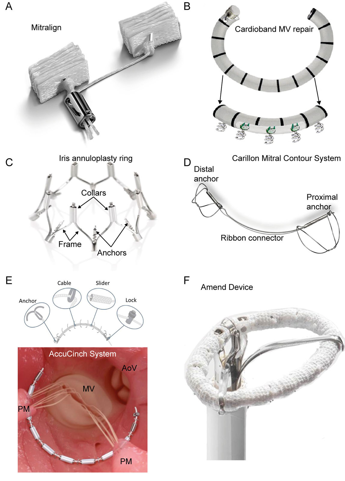 Transcatheter MV repair systems. These are photos of percutaneous annuloplasty type devices for MV repair, including the (A) Mitralign System, (B) Cardioband Mitral Valve Repair System, (C) IRIS complete Annuloplasty Ring, (D) Carillon Mitral Contour System, (E) AccuCinch System, (F) Amend Device.<em> Abbreviations</em>: PM, papillary muscle; MV, mitral valve; AoV, aortic valve.