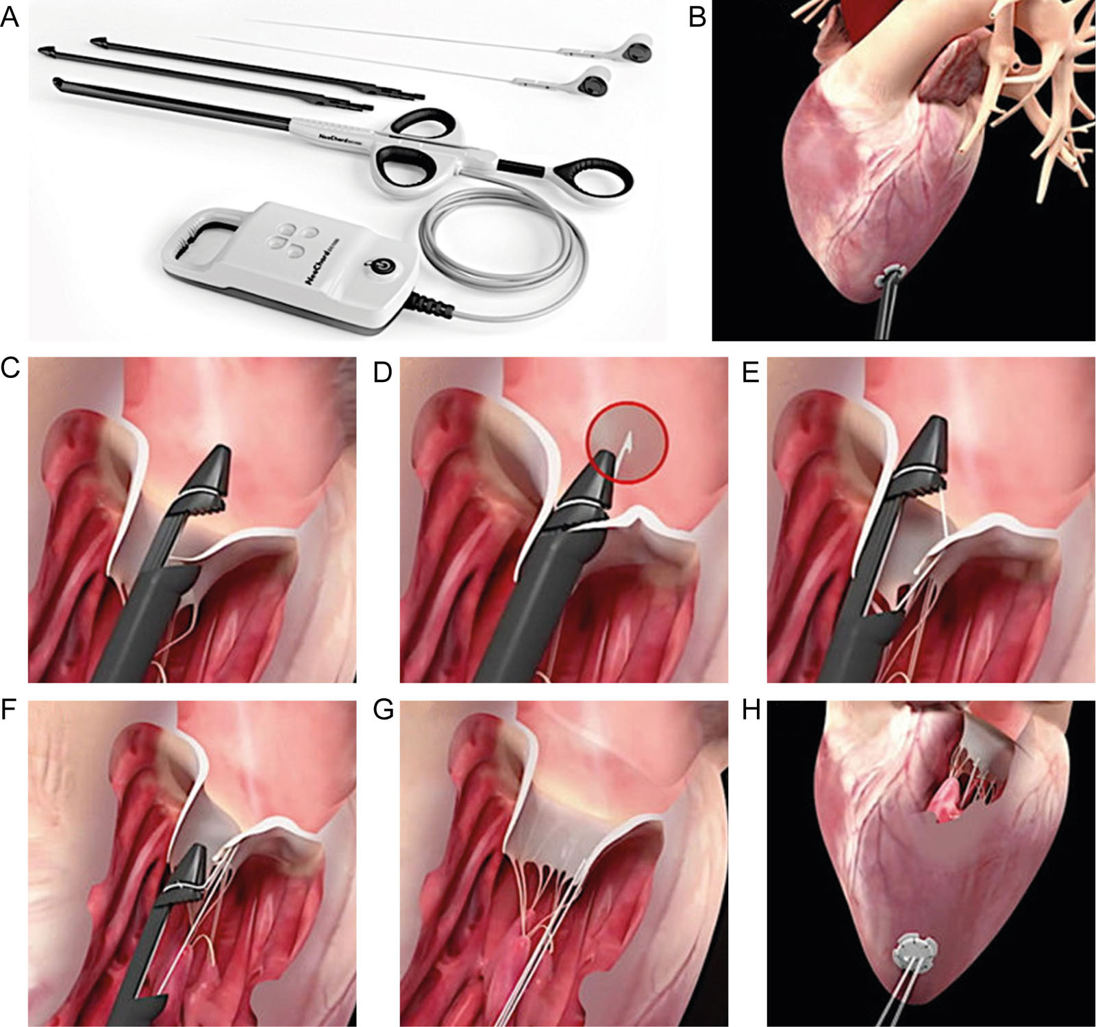 Transcatheter MV repair system. This figure describes the (A) Neochord system for transcatheter mitral valve repair with insertion (B) through the LV apex. (C) Once the tip has crossed the valve, the jaws are opened, and the leaflet edge is grasped by withdrawing the device from the LA. (D, E) The leaflet is pierced through a needle and a loop of the suture is deployed. (F, G) The device is retrieved, exteriorizing the chordal loop; a girth hitch knot is formed. (H) The length of each neo‐chordae is set until adequate coaptation is reached, under real‐time TEE; each of the neo‐chordae is fixed to an epicardial Teflon pledget.<em> Abbreviations</em>: LA, left atrium; LV, left ventricle; MV, mitral valve; TEE, transesophageal echocardiography. With permission from D’Onofrio et al. <sup>85</sup> With permission of neochord DS1000 System (Neochord, Inc).