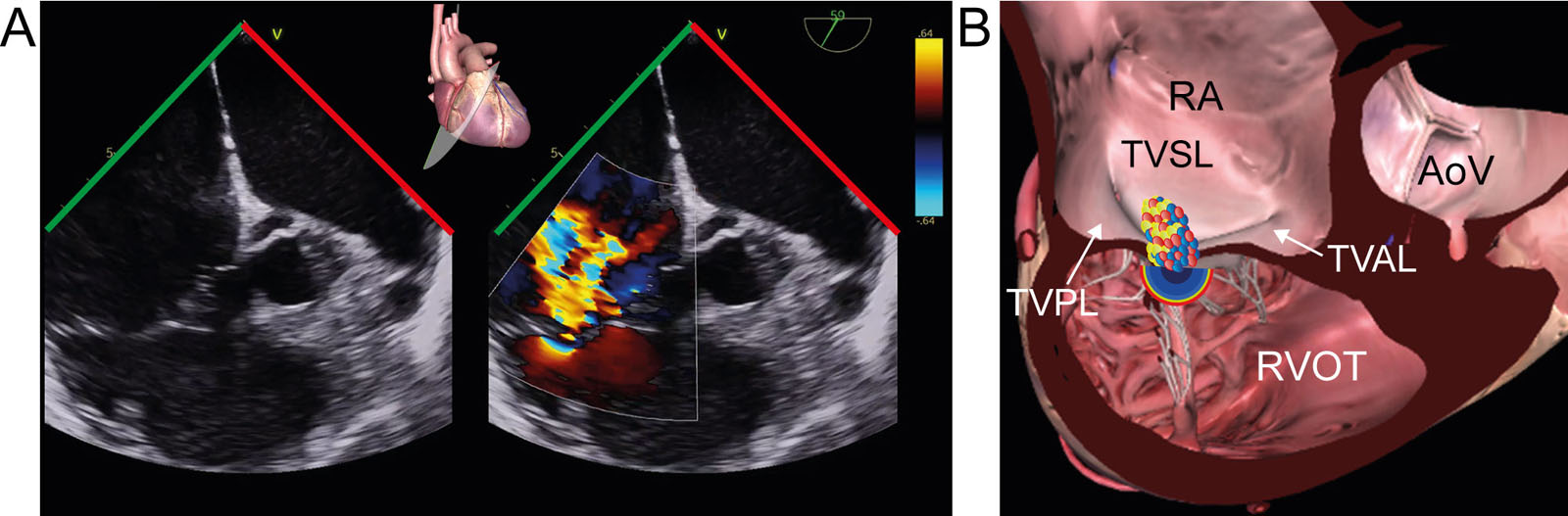 DE right ventricular inflow/outflow view of the TV. (A,B) This color compare DE view shows both the TVPL and TVAL with and without CFI. (C) This is a diagram of the TV from the RA perspective in the surgeon’s orientation, showing the plane.<em> Abbreviations</em>: AoV, aortic valve; CFI, color flow imaging; DE, deep esophageal; RA, right atrium; RVOT, right ventricular outflow tract; TV, tricuspid valve; TVAL, tricuspid valve anterior leaflet; TVPL, tricuspid valve posterior leaflet; TVSL, tricuspid valve septal leaflet.<i class='fa fa-video-camera' aria-hidden='true'></i>