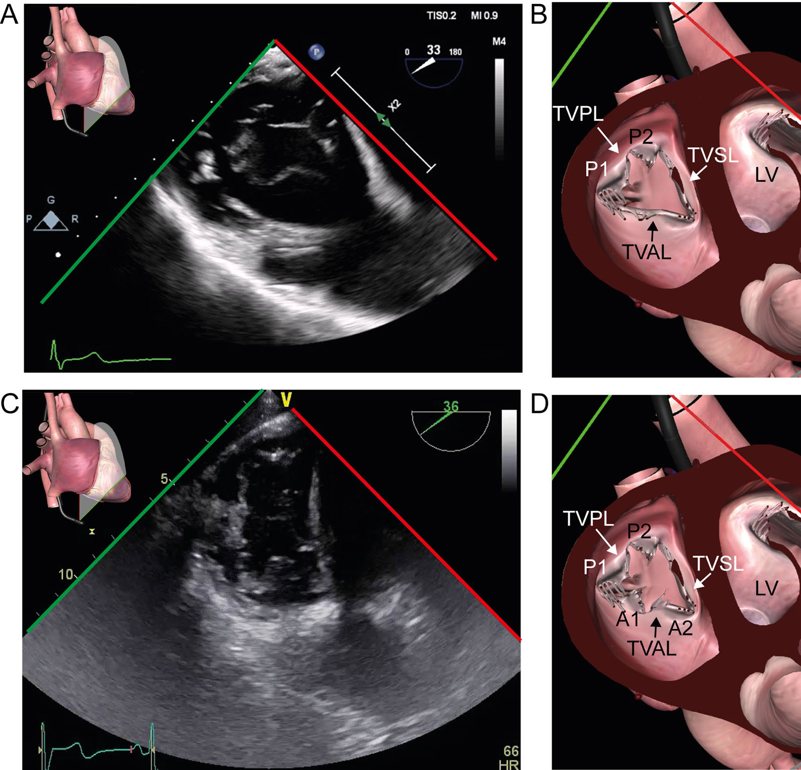 TV anatomic variants. (A-D) These TG basal views of the TV show (A, B) type IIIB with two posterior leaflets and (C, D) type IV with 2 anterior and 2 posterior leaflets.<em> Abbreviations</em>: A, anterior; LV, left ventricle; P, posterior; TG, transgastric; TV, tricuspid valve; TVAL, tricuspid valve anterior leaflet; TVPL, tricuspid valve posterior leaflet; TVSL, tricuspid valve septal leaflet. <i class='fa fa-video-camera' aria-hidden='true'></i>