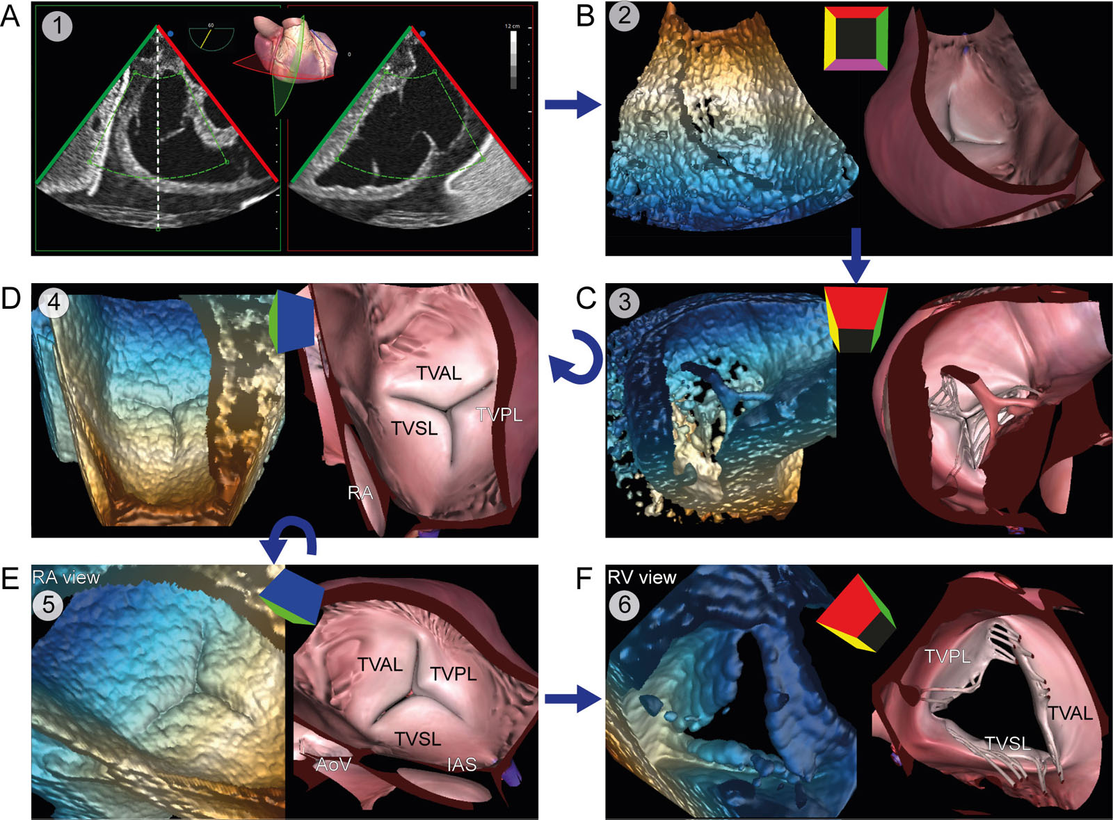 TV 3D zoom acquisition. (A) 3D zoom acquisition should include all three TV leaflets, the TA, and part of the AoV. (B) The acquired 3D frustrum undergoes (C) rotation to (D) display the TV from the RA perspective. (E) Rotation of the RA perspective displays the TV in the surgeon’s orientation. (F) A 180° rotation allows the visualization of an RV view of the TV.<em> Abbreviations</em>: 3D, three-dimensional, AoV, aortic valve; IAS, interatrial septum; RA, right atrium; RV, right ventricle; TA, tricuspid annulus; TV, tricuspid valve; TVAL. Tricuspid valve anterior leaflet; TVPL, tricuspid valve posterior leaflet; TVSL, tricuspid valve septal leaflet. <i class='fa fa-video-camera' aria-hidden='true'></i>