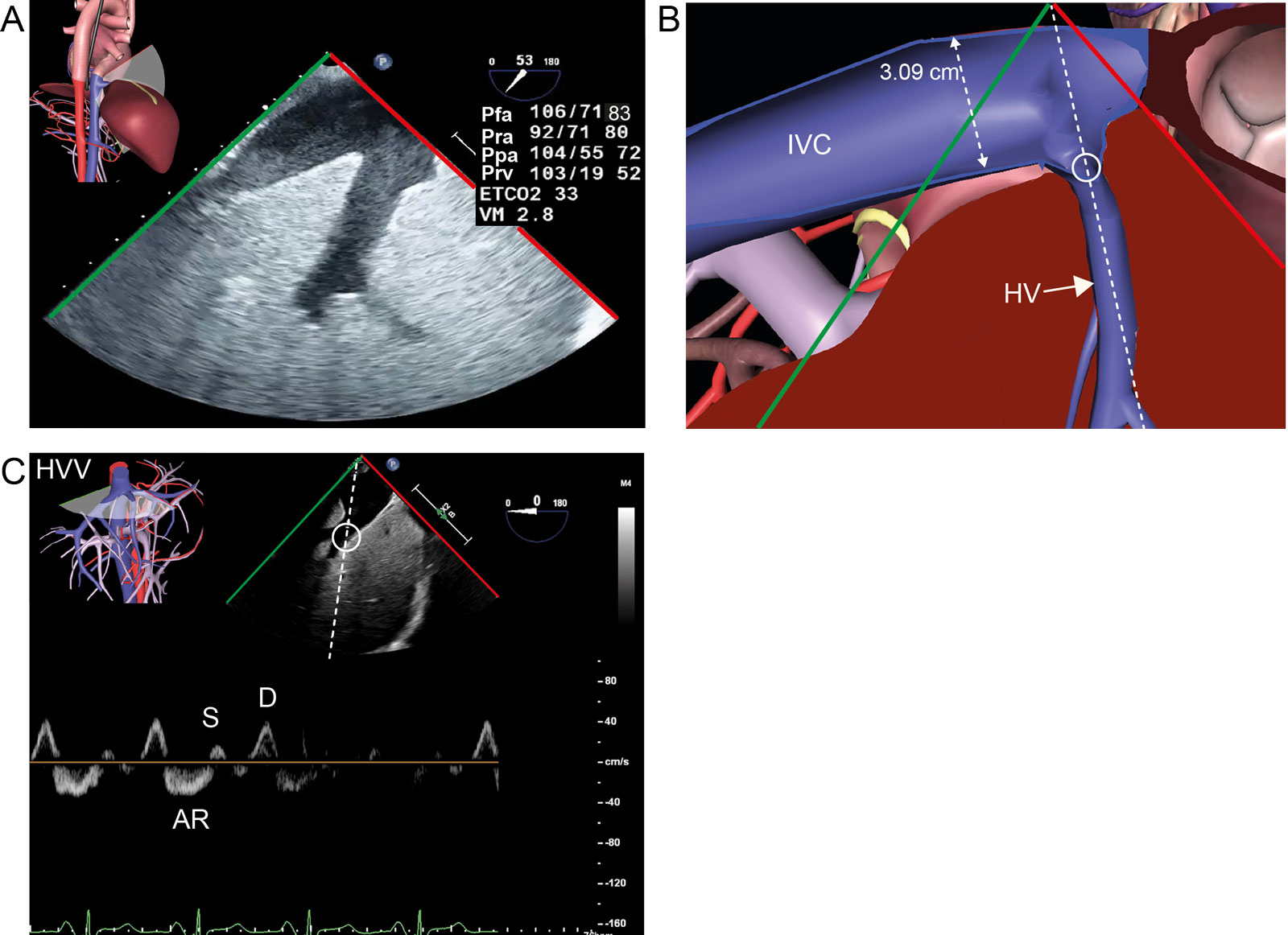 Quantification of TR severity. This is a 76-year-old patient with a history of severe MR. (A,B) TGAUS longitudinal IVC view shows a dilated IVC. (C) The HVV PWD interrogation has systolic blunting with a smaller S compared to D and pronounced AR. TR was moderate in this case.<em> Abbreviations</em>: AR, atrial reversal HVV; D, diastolic HVV; ETCO2, end-tidal CO2; HV, hepatic vein; HVV, hepatic vein velocity; IVC, inferior vena cava; MR, mitral regurgitation; MV, minute ventilation; Pfa, femoral arterial pressure; Ppa, pulmonary artery pressure; Pra, right atrial pressure; Prv, right ventricular pressure; PWD, pulsed-wave Doppler; S, systolic HVV; TGAUS, transgastric abdominal ultrasound; TR, tricuspid regurgitation. <i class='fa fa-video-camera' aria-hidden='true'></i>