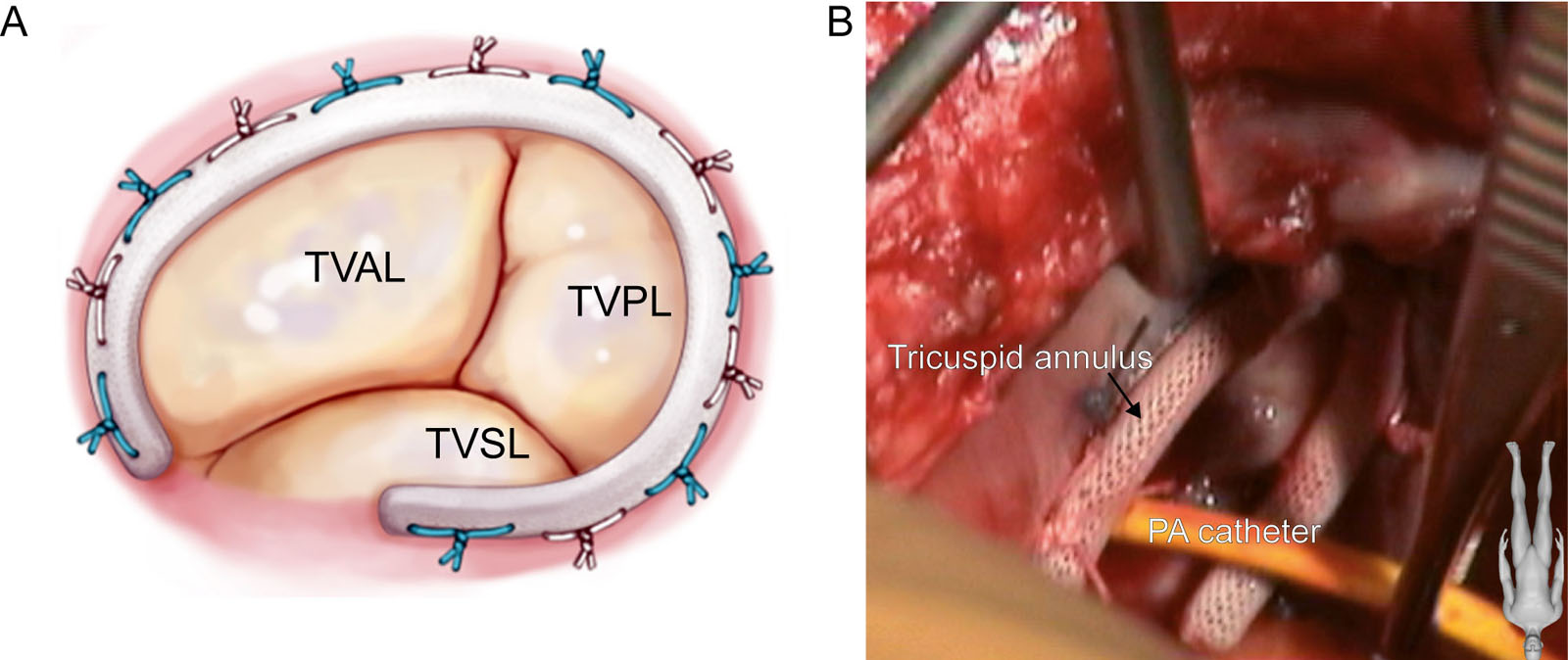 Annuloplasty ring. This is an Edwards® M3C tricuspid annuloplasty ring during implantation in (A) diagram of the TV and (B) an intraoperative photo from the RA.<em> Abbreviations</em>: PA, pulmonary artery; RA, right atrium; TV, tricuspid valve; TVAL, tricuspid valve anterior leaflet, TVPL, tricuspid valve posterior leaflet, TVSL, tricuspid valve septal leaflet. <i class='fa fa-video-camera' aria-hidden='true'></i>