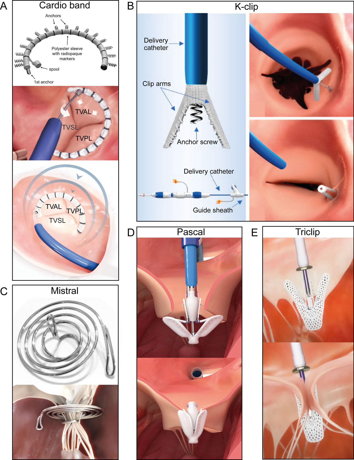 Transcatheter TV repair systems. These are examples of transcatheter TV repair systems, including annuloplasty devices such as the (A) Cardioband (Edwards Lifesciences, Irvine CA, USA) and (B) K-ClipTM (Huihe Co, China)<sup>82</sup>; subvalvular chordae tendinae approximation devices like the (C) Mistral (Mitralix, Israël) and clip devices (D) Pascal (Edwards Lifesciences, Irvine CA, USA)<sup>83</sup> and (E) Triclip (Abbott Vascular, Santa Clara, CA, USA).<em> Abbreviations</em>: TV,tricuspid valve; TVAL, tricuspid valve anterior leaflet; TVPL, tricuspid valve posterior leaflet; TVSL, tricuspid valve septal leaflet. <i class='fa fa-video-camera' aria-hidden='true'></i>