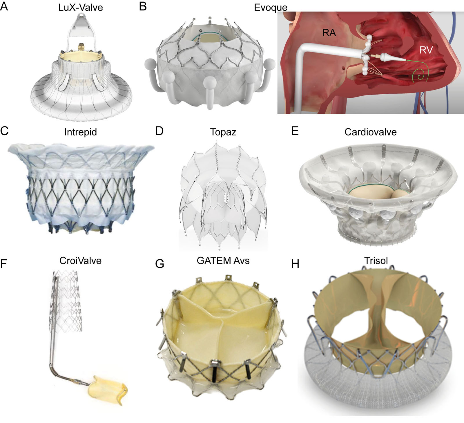 Transcatheter TV orthotopic bioprosthesis. These valves require transfemoral access for implantation, including the (A) LuX-Valve (Jenscare Scientific Co, Ningbo, PRC)<sup>84</sup>, (B) EVOQUE (Edwards Lifesciences, Irvine, CA, USA), (C) Intrepid (Medtronic, Minneapolis, MN USA), (D) Topaz (TRiCares GmbH, Munich, Germany) and (E) Cardiovalve (Venus Medtech, Hangzhou, PRC) These valves require transjugular access for implantation, including the (F) Duo tricuspid coaptation valve system (CroiValve, Dublin, Ireland)<sup>55</sup>, (G) GATETM Avs–atrioventricular valved stent (NaviGate Cardiac Structures Inc., Lake Forest, CA, USA) and the (H) Trisol (Trisol Medical, Yokneam, Israel).<em> Abbreviations</em>: RA, right atrium; RV, right ventricle; TV, tricuspid valve. <i class='fa fa-video-camera' aria-hidden='true'></i>