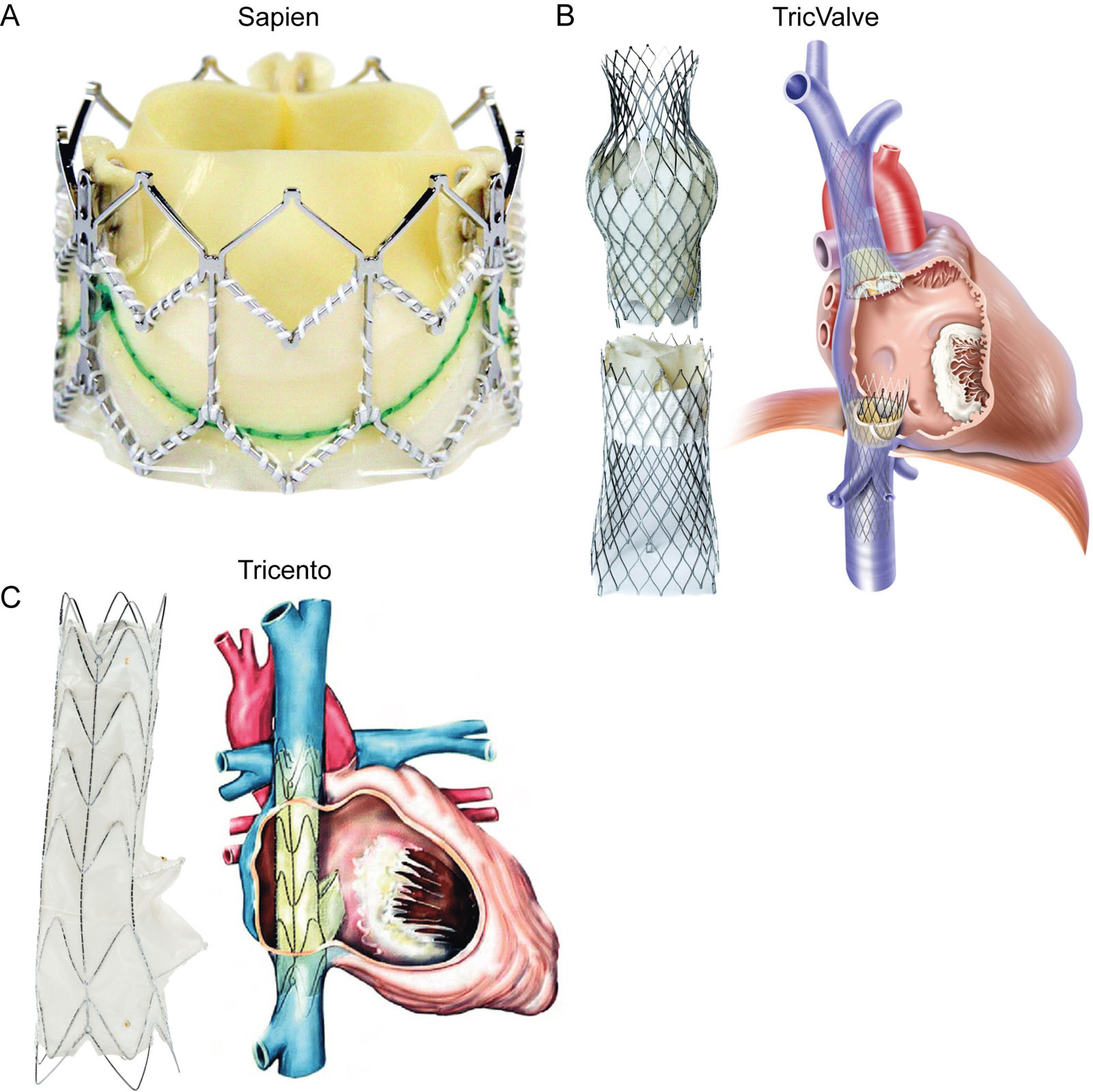 Transcatheter heterotopic bioprosthesis for TR. These are examples of bioprosthetic valves implanted into the IVC and SVC to treat severe TR, including the (A) Sapien XT–Sapien 3 IVC or bicaval IVC+SVC implants (Edwards Lifesciences, Irvine, CA USA). (B) TricValve<sup>R</sup> Transcatheter bicaval valves system (P+F Products + Features, Vienna, Austria. (C) Tricento (New Valve Technology NVT GmbH, Hechingen, Germany).<em> Abbreviations</em> : IVC, inferior vena cava; SVC, superior vena cava; TR, tricuspid regurgitation. <i class='fa fa-video-camera' aria-hidden='true'></i>
