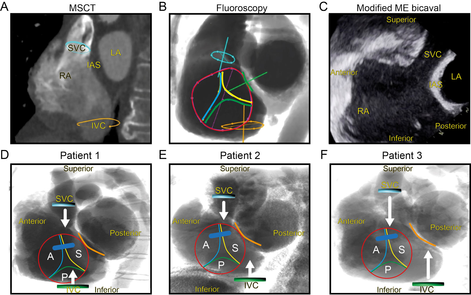Preprocedural imaging for tricuspid intervention. This is the (A) preprocedural cardiac CTA and (B) corresponding fluoroscopic view with projection of the TV leaflets. (C) From the corresponding TEE bicaval view, the image display would need counterclockwise rotation and then left-right inversion to match the fluoroscopic view. (D) The lower row shows similar fluoroscopic LAO caudal one-chamber en-face views of the TV in three different patients, revealing a variable degree of TV position offset (red circle) from the SVC (blue) and the IVC (green) orifices. This explains how the alignment between the SVC, IVC and TV varies between patients. In patient #3, the catheter arriving from the IVC will encounter the septum.<em> Abbreviations</em>: A, anterior; CTA, computed tomography angiography; IAS, interatrial septum; IVC, inferior vena cava; LA, left atrium; LAO, left anterior oblique; ME, mid-esophageal; MSCT, multi-slice computed tomography; P, posterior; RA, right atrium; S, septal; SVC, superior vena cava; TEE, transesophageal echocardiography; TV, tricuspid valve.