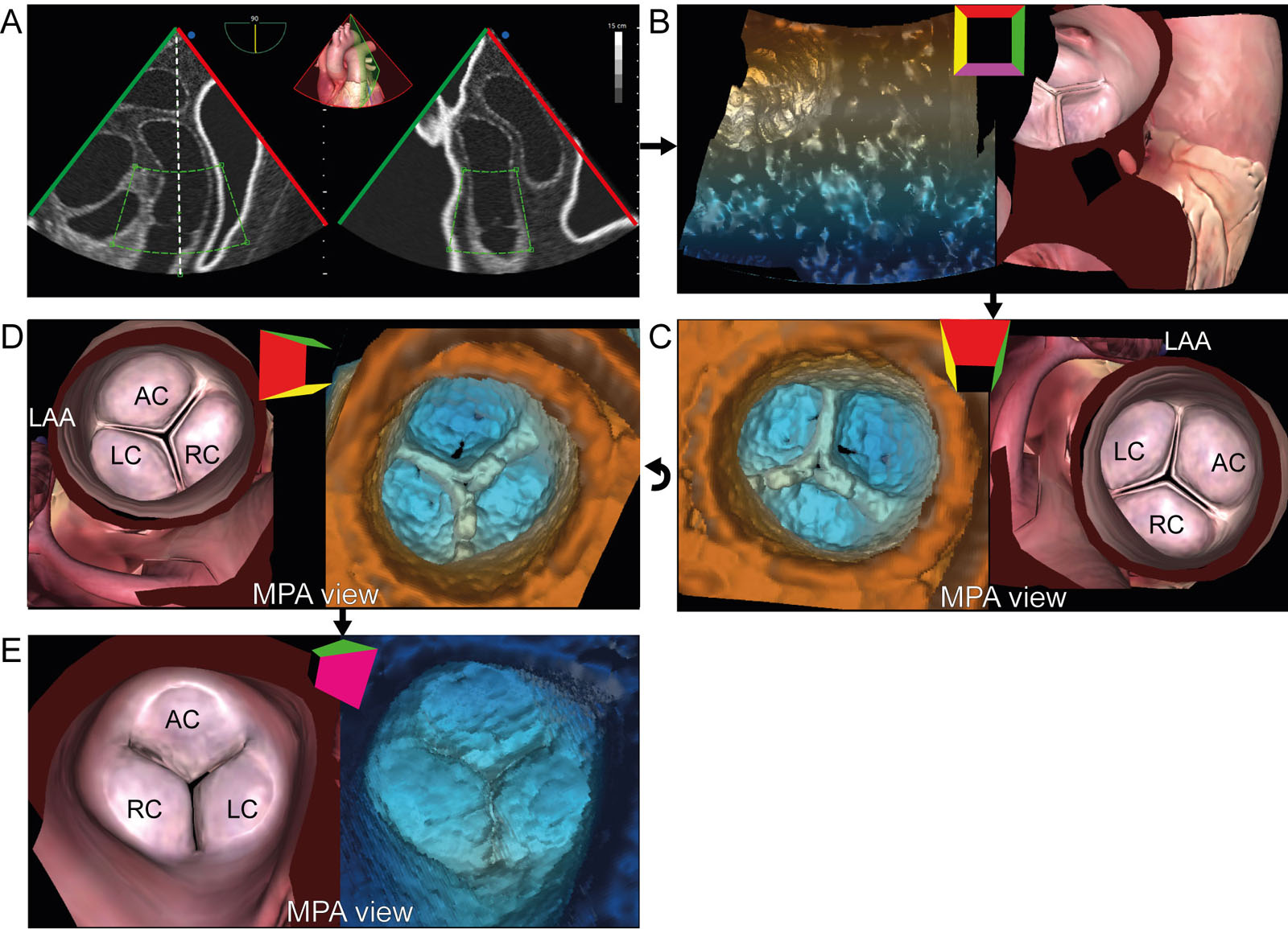 PV 3D zoom acquisition. (A) 3D zoom acquisition from an ME view should include all 3 PV cusps, and slight portions of the AoV, aorta and LAA. (B) A 3D frustrum is acquired and (C) rotated downward and (D) to the left. An MPA view of the PV is obtained. (E) Slight counterclockwise rotation leads to the recommended PV from an MPA perspective. (F) A 180° rotation allows visualization of the PV through the RV.<em> Abbreviations</em>: 3D, three-dimensional; AC, anterior cusp; AoV, aortic valve; LAA, left atrial appendage; LC, left cusp; ME, mid-esophageal; MPA, main pulmonary artery; PV, pulmonic valve; RC, right cusp; RV, right ventricle. Adapted from Hahn et al. <strong><sup>2</sup></strong>. <i class='fa fa-video-camera' aria-hidden='true'></i>