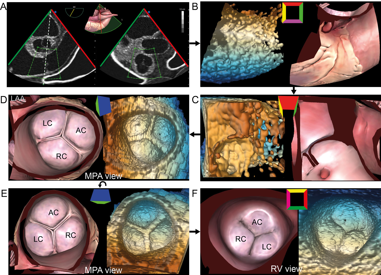 PV 3D dataset. This is the acquisition sequence using 3D zoom to obtain an en-face view of the PV from a UE Arch SAX view. (A) 3D zoom acquisition centers the PV in the acquisition box including all 3 PV cusps, and slight portions of the AoV, Ao and the LAA (B) A 3D frustrum is acquired and (C) rotated downward and (D) to the left to show the PV from a MPA perspective. (E) Counterclockwise rotation 90° leads to the recommended PV orientation with the AC at 12 o’clock from an MPA perspective. (F) A 180° rotation shows the PV from the RVOT perspective.<em> Abbreviations</em>: 3D, three-dimensional; AC, anterior cusp; Ao, aorta; AoV, aortic valve; LA, left atrium; LAA, left atrial appendage; LC, left cusp; MPA, main pulmonary artery; PV, pulmonic valve; RC, right cusp; RV, right ventricle; RVOT, right ventricular outflow tract; SAX, short-axis; UE, upper esophageal. Adapted from Hahn et al.<strong><sup>2</sup></strong>.