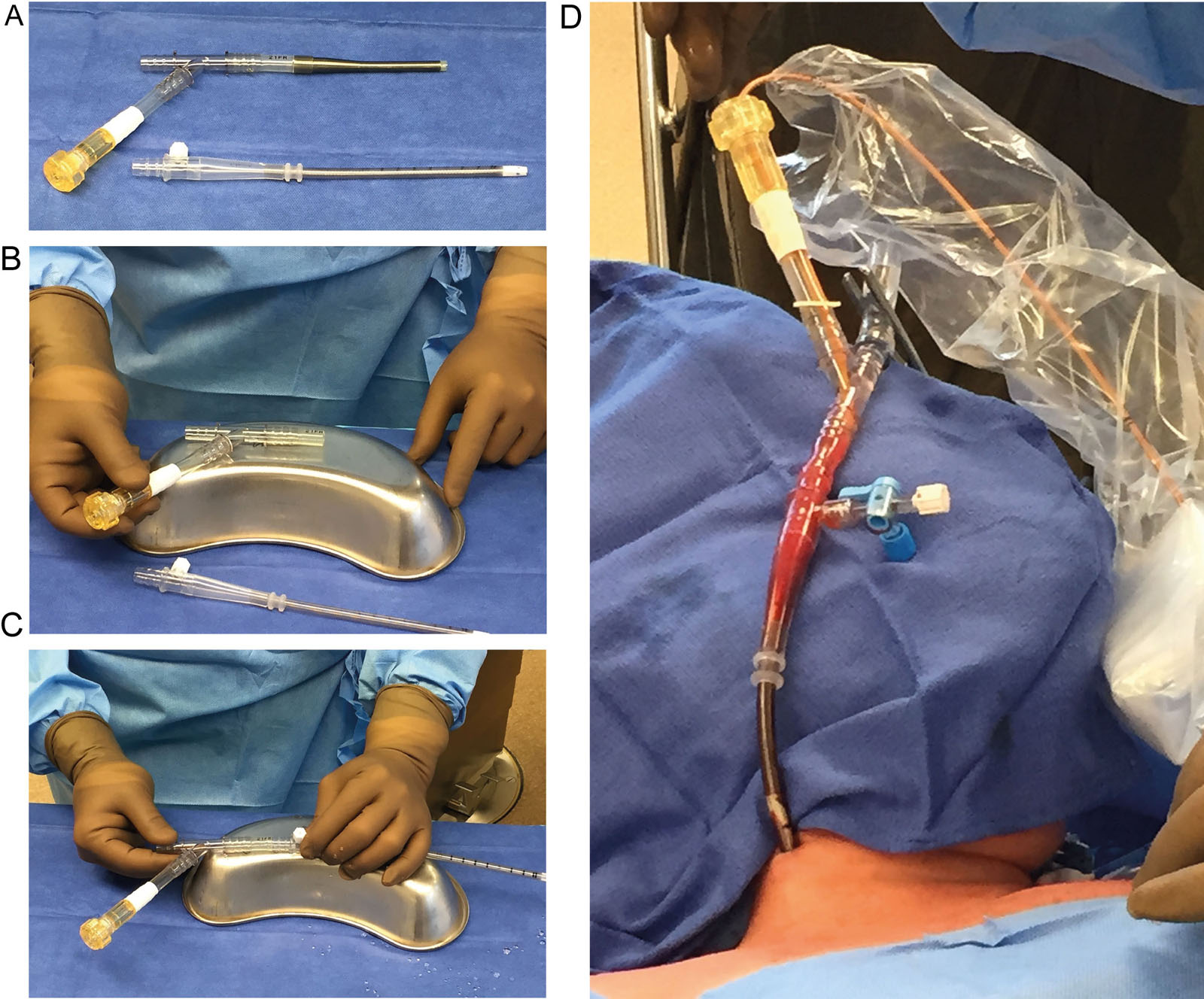 Endovascular vena cavae occlusion technique. (A) Arterial Y-shaped cannula and arterial cannula used as a venous cannula. (B) The anesthesiologist cuts the arterial cannula portion and keeps the EndoReturn hemostasis valve portion. (C) The modified venous cannula for right internal jugular vein cannulation with the EndoReturn hemostatic valve portion connected to the arterial cannula. (D) CODA balloon catheter introduced into the modified venous cannula. The CODA catheter inserts into a sterile sheath. Adapted from Yamani et al.<sup>52</sup>