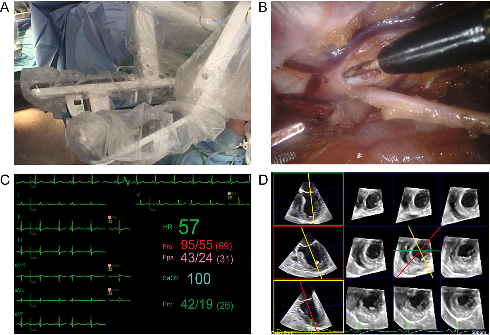 Robotic surgery monitoring. (A,B) External and internal view of the robotic system used to perform coronary revascularization. Lung isolation allows LIMA dissection. (C,D) Electrocardiographic (7 lead) and 3D multi-slice reconstruction monitoring of myocardial ischemia.<em> Abbreviations</em>: 3D, three-dimensional; HR, heart rate; LIMA, left internal mammary artery; Ppa, pulmonary artery pressure; Pra, radial arterial pressure; Prv, right ventricular pressure, SaO2, oxygen saturation. <i class='fa fa-video-camera' aria-hidden='true'></i>