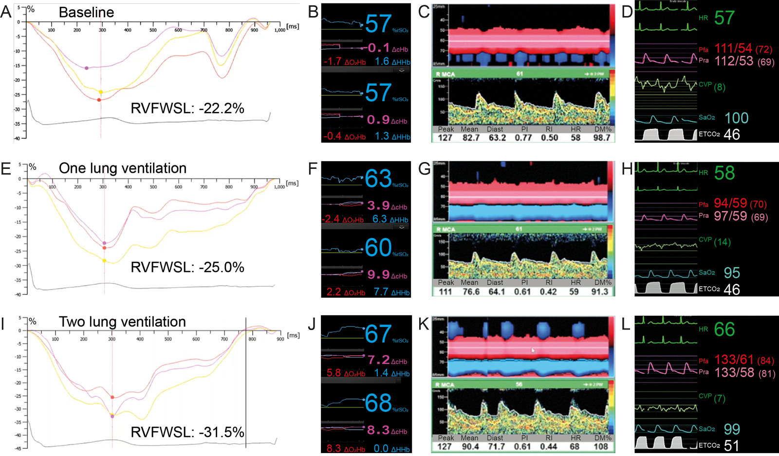 RV strain and Anrep effect. A 68-year-old man is undergoing robotic revascularization with single lung ventilation. Compare the RVFWSL, second generation cerebral rSO<sub>2,</sub> TCD on the RMCA, and hemodynamic parameters at (A-D) baseline, (E-H) during one lung ventilation and (I-L) back on two lung ventilation. There is an increase in RVFWSL during one lung ventilation associated with a parallel increase in rSO<sub>2</sub>, ETCO<sub>2</sub> and CVP, but transient reduction in TCD and both Pfa and Pra. The combination of a rise in carbon dioxide and an Anrep effect can explain the increase in strain and in rSO<sub>2</sub> values.<em> Abbreviations</em>: DcHbi, change in total hemoglobin index; DHhbi, change in deoxygenated hemoglobin index; DO<sub>2</sub>Hbi, change in oxygenated hemoglobin index; CVP, central venous pressure; Diast, diastolic; DM%, delta mean or % compared to baseline mean velocity; ETCO<sub>2</sub>, end-tidal carbon dioxide; HR, heart rate; Pfa, femoral arterial pressure;PI, pulsatility index; Pra, radial arterial pressure; RI, resistance index; RMCA, right middle cerebral artery; rSO<sub>2</sub>, regional oxygen saturation; RV, right ventricle; RVFWSL, right ventricular free wall strain longitudinal; SaO2, oxygen saturation; TCD, transcranial Doppler.