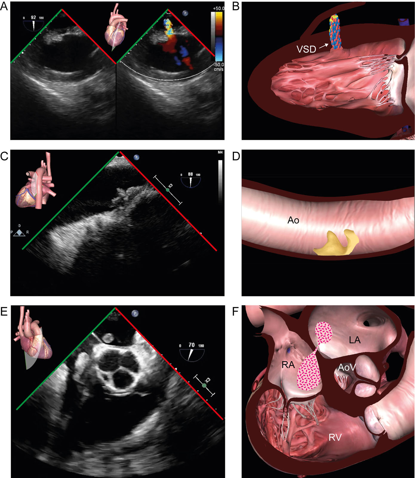 Assist devices contraindications. These are some contraindications to the insertion of assist devices, including (A,B) a VSD seen in the TG 2C view, (C,D) grade 5 aortic atherosclerosis and a mobile plaque seen in the LAX thoracic aortic view and (E, F) thrombus across a PFO appearing in the ME RV inflow-outflow view.<em> Abbreviations</em>: 2C, two-chamber; Ao, aorta; AoV, aortic valve; LA, left atrium; LAX, long-axis; ME, mid-esophageal; PFO, patent foramen ovale; RA, right atrium; RV, right ventricle; TG, transgastric; VSD, ventricular septal defect. <i class='fa fa-video-camera' aria-hidden='true'></i>
