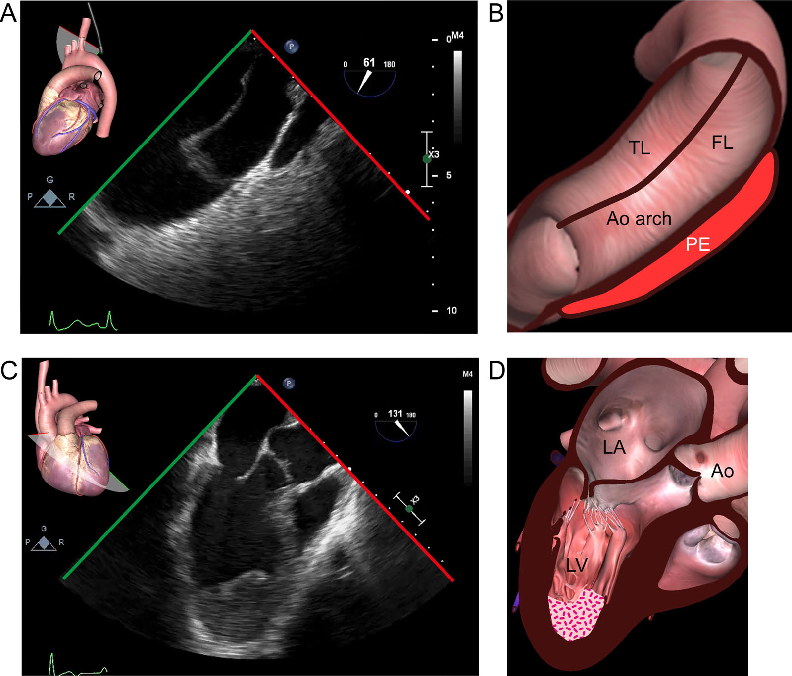 Impella® device contraindications. Some contraindications to using the Impella® device include (A,B) aortic dissection as seen in this UE view of the aorta and (C,D) LV apical thrombus as appears in this ME LAX view.<em> Abbreviations</em>: Ao, aorta; FL, false lumen; LA, left atrium; LAX, long-axis; LV, left ventricle; ME, mid-esophageal; PE, pericardial effusion; TL, true lumen; UE, upper esophageal. <i class='fa fa-video-camera' aria-hidden='true'></i>