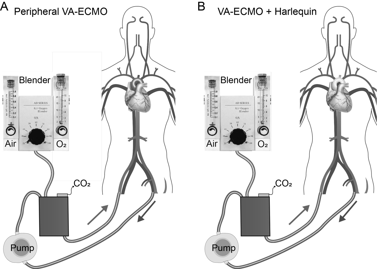 Peripheral V-A ECMO. (A) Normal gas exchange. (B) Differential gas exchange. Red blood: reinfused oxygenated blood from the ECMO circuit. Blue blood: venous blood drained by ECMO circuit. Purple blood: relatively deoxygenated blood ejected from the LV in the setting of impaired native lung gas exchange leading to a Harlequin syndrome where the face and upper extremity are blue and the legs are red.<em> Abbreviations</em>: ECMO, extracorporeal membrane oxygenator; LV, left ventricular; V-A, veno-arterial. Adapted from Asija et al.<strong><sup>37</sup></strong>