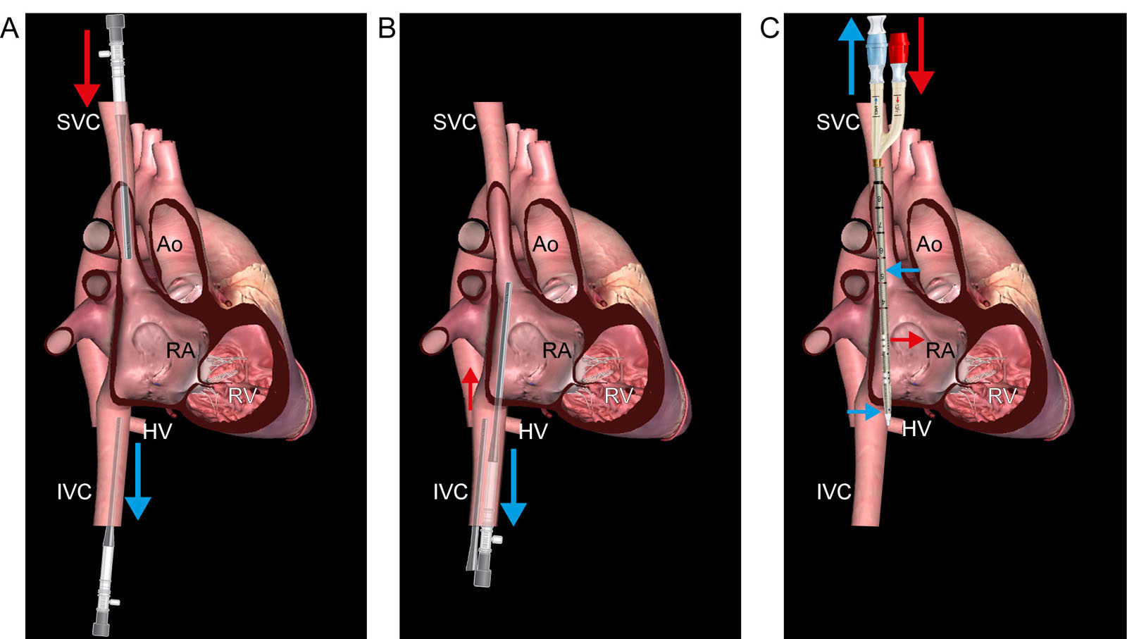 V-V ECMO cannulation techniques. These diagrams show a few different options for V-V ECMO cannulation, including (A) femoral-jugular, (B) femoral-femoral and (C) dual-lumen cannula. In femoral-femoral cannulation, a distance ≥ 5 cm must separate the tips of the drainage and reinfusion/return cannula to avoid recirculation.<em> Abbreviations</em>: Ao, aorta; ECMO, extra-corporeal membrane oxygenation; HV, hepatic vein; IVC, inferior vena cava; RA, right atrium; RV, right ventricle; SVC, superior vena cava; V-V, veno-venous. Adapted from Banfi<sup>43</sup> and Burrel et al.<sup>96</sup>