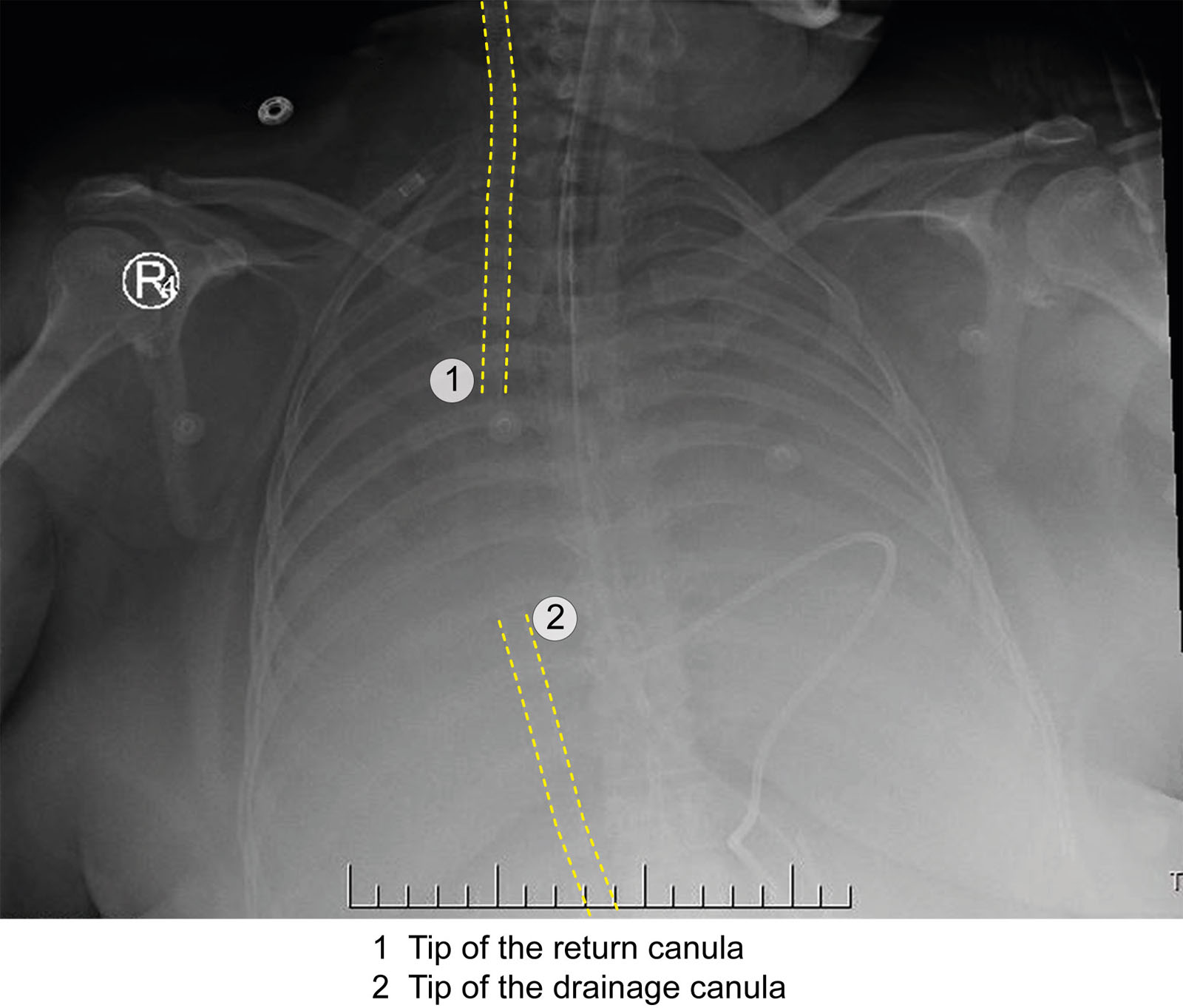 V-V ECMO cannulae position. This CXR shows the multistage access cannula tip positioned at the RA/SVC junction, whereas the return cannula is ≥ 5cm above the proximal drainage hole.<em> Abbreviations</em>: CXR, chest x-ray; ECMO, extracorporeal membrane oxygenation; RA, right atrium; SVC, superior vena cava; V-V, veno-venous. Adapted from the The Alfred ICU (https://www.alfredicu.org.au/) and the Intensive blog (https://intensiveblog.com/ecmo/).
