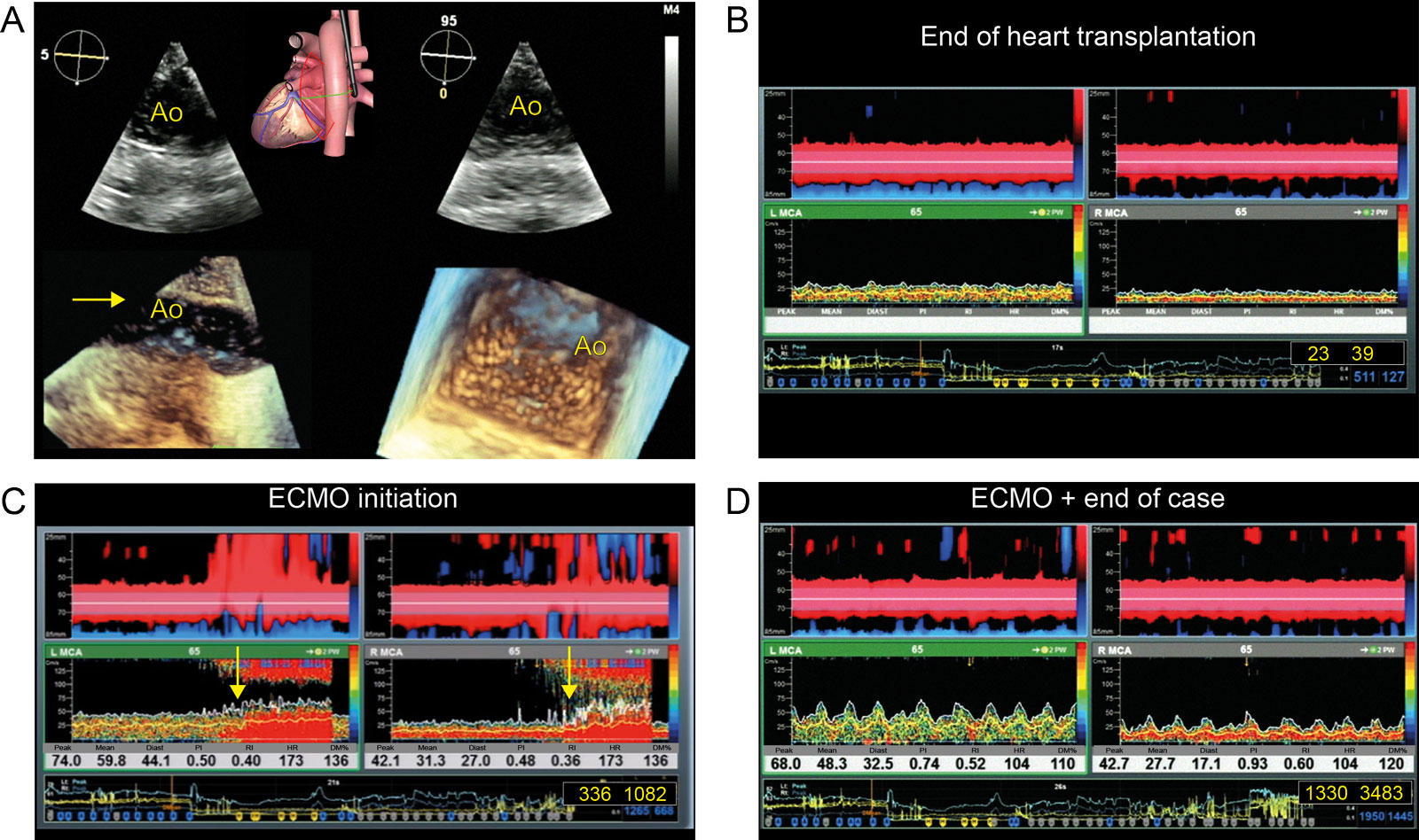 Brain monitoring during ECMO. This is a patient undergoing heart transplantation who required ECMO. (A) Descending aorta biplane and 3D views show air (arrows) in the aortic lumen. (B-D) This was associated with the appearance of HITS in both the left and right cerebral territories (yellow arrows). Following ECMO initiation, the total number of HITS increased significantly on the right from 23 to 1330 and on the left from 39 to 348.<em> Abbreviations</em>: 3D, three-dimensional; Ao, aorta; Diast, diastole; DM%, % percentage of mean velocity changes or delta in relation to the baseline value; ECMO, extra-corporeal membrane oxygenation; HITS, high-intensity transient signals; HR, heart rate MCA, right middle cerebral artery; PI, pulsatility index; RI, resistance index. Adapted from Noel et al. <strong><sup>54</sup></strong> <i class='fa fa-video-camera' aria-hidden='true'></i>