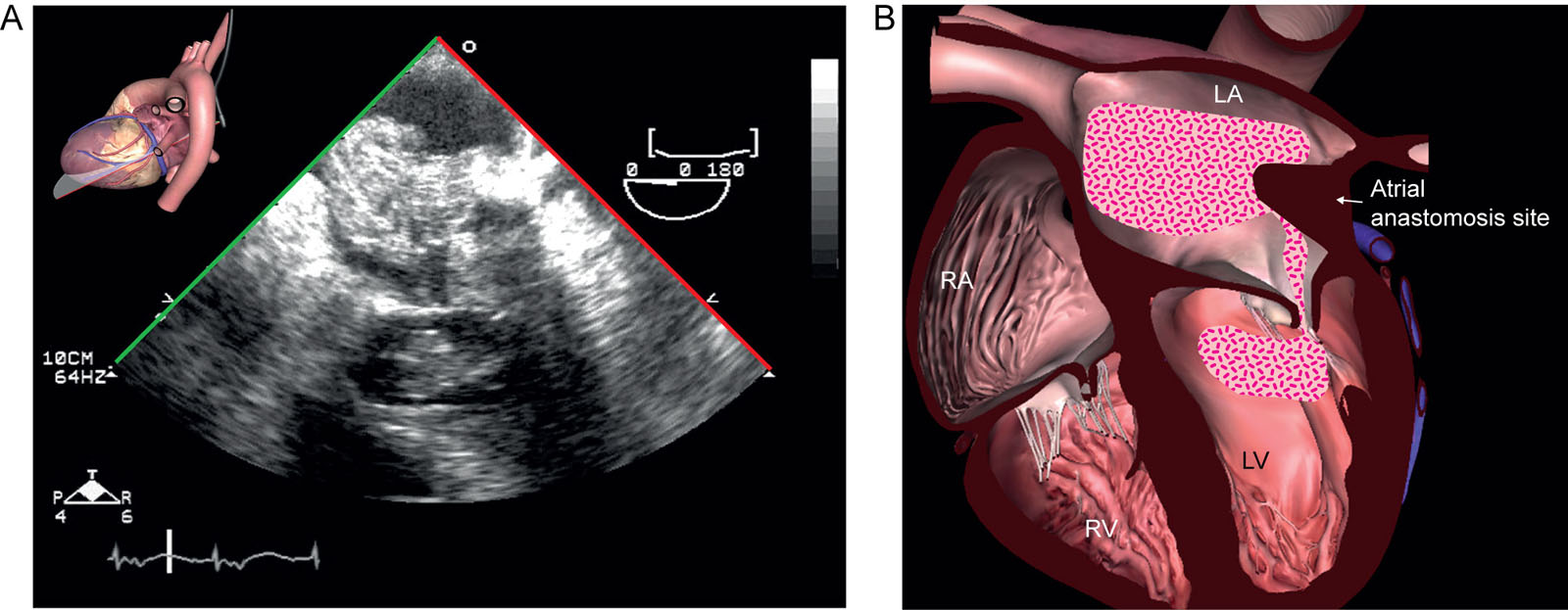 ECMO complication. A 64-year-old man is on a centrifugal pump for cardiogenic shock after heart transplantation. (A, B) ME 4C views show an unexpected LA and LV thrombus attached to the atrial anastomosis site on the third day.<em> Abbreviations</em>: 4C, four chamber; ECMO, extracorporeal membrane oxygenation; LA, left atrium; LV, left ventricle; ME, mid-esophageal; RA, right atrium; RV, right ventricle. <i class='fa fa-video-camera' aria-hidden='true'></i>