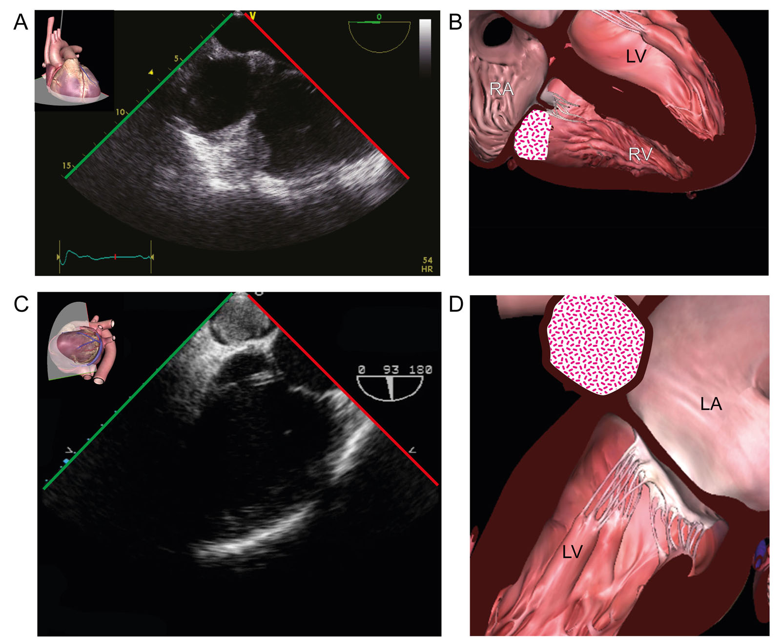 Thrombus prior to OHT. (A, B) ME RV view at 148° and (C, D) an RV focused ME 4C (C, D) show a laminated thrombus in the RV under the TVAL in a 49-year-old woman prior to OHT. (E, F) Coronary sinus thrombus (arrow) prior to OHT.<em> Abbreviations</em>: 4C, four-chamber; LA, left atrium; LV, left ventricle; ME, mid-esophageal; OHT, orthotopic heart transplantation; RA, right atrium; RV, right ventricle; TVAL, tricuspid valve anterior leaflet. <i class='fa fa-video-camera' aria-hidden='true'></i>