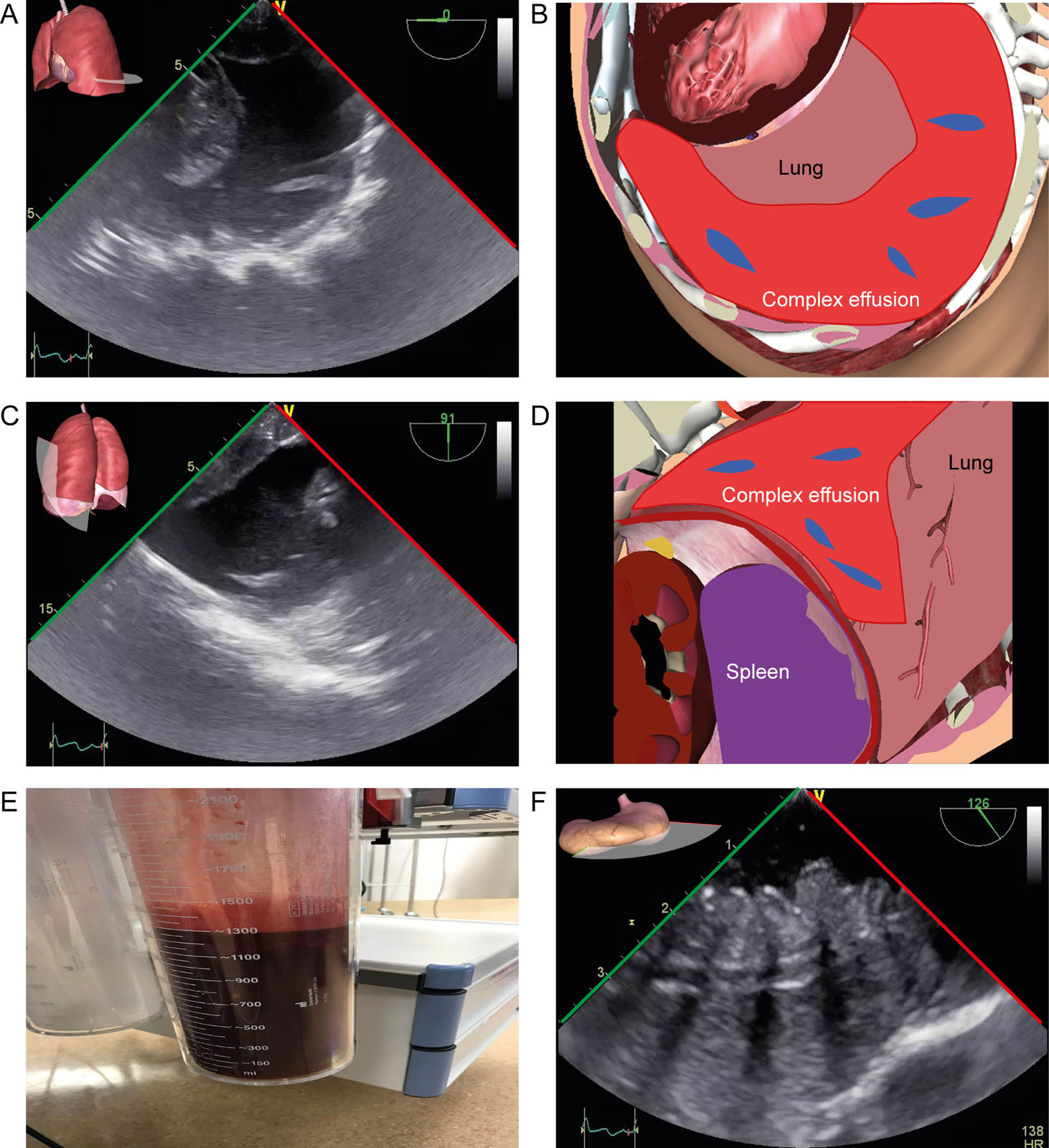 Complex effusion before OHT. (A-D) TELUS at the base of the left lung at 0° and 91° show a 1300ml complex effusion with fibrin. (E) which was removed prior to OHT. (F) There was also severe stomach wall edema.<em> Abbreviations</em>: OHT, orthotopic heart transplantation; TELUS, transesophageal lung ultrasound. <i class='fa fa-video-camera' aria-hidden='true'></i>