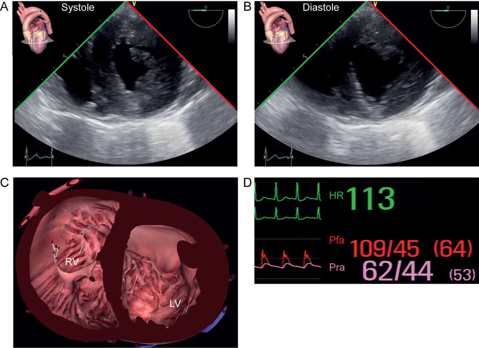 LV function post OHT. (A-C) TG mid-papillary SAX views in systole and diastole after OHT show abnormal LV septal motion with a D-shaped septum in diastole. (D) Note the significant systolic arterial pressure gradient between the Pra and Pfa.<em> Abbreviations</em>: HR, heart rate; LV, left ventricle; ME, mid-esophageal; OHT, orthotopic heart transplantation; Pfa, femoral arterial pressure; Pra, radial arterial pressure; RV, right ventricle; SAX, short-axis; TG, transgastric. <i class='fa fa-video-camera' aria-hidden='true'></i>