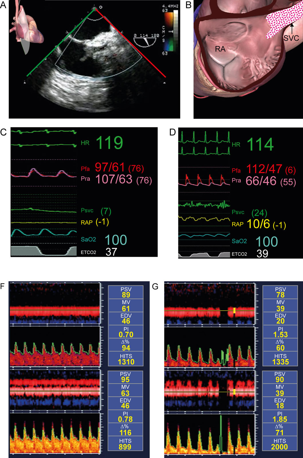 SVC thrombus after OHT. (A-C) ME bicaval view shows an SVC thrombus. (D, E) Hemodynamic parameters before and after OHT show the mean RAP in the SVC was 7 mmHg but increased to 24 mmHg and there was a significant new Pfa (112 mmHg) to Pra (66 mmHg) gradient. (F, G) TCD shows an increase in the PI consistent with elevated cerebral venous pressure.<em> Abbreviations</em>: D%, delta or change compared to baseline MV; EDV, end-diastolic velocity; ETCO<sub>2</sub>, end-tidal carbon dioxide; HITS, high-intensity transient signals; HR, heart rate; ME, mid-esophageal; MV, mean velocity; OHT, orthotopic heart transplantation; Pfa, femoral arterial pressure; PI, pulsatility index; Pra, radial arterial pressure; PSV, peak systolic velocity; Psvc, pressure at SVC entrance; RA, right atrium; RAP, right atrial pressure; SaO2, arterial oxygen saturation; SVC, superior vena cava; TCD, transcranial Doppler. <i class='fa fa-video-camera' aria-hidden='true'></i>