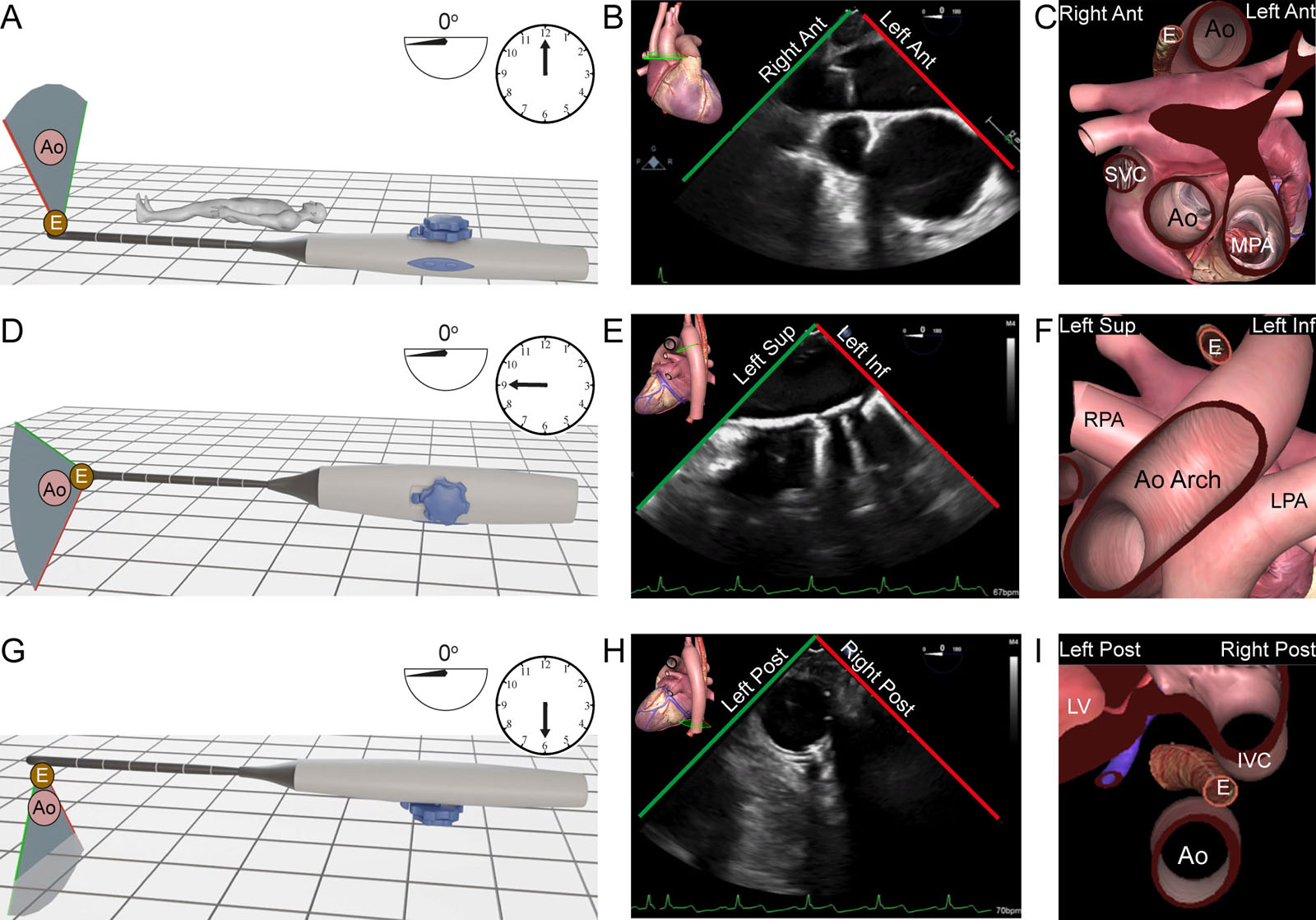 TEE thoracic aorta examination. These diagrams show the relationship between the TEE probe and the structures displayed during the thoracic aorta examination. (A-D) ME Asc Ao SAX view. In this position, the dual rotating knob position is anterior at 12 o’clock and the US beam is at 0°. In the 2D image, the right screen (red line) has the left anterior anatomic structures like the MPA and the left screen (green line) the right anterior anatomic structures like the SVC. The Ao lies anterior to the esophagus. (E-H) UE aortic arch SAX view. The dual rotating knob position is to the left of the patient at 9 o’clock and the US beam is at 0°. In the 2D image, the right screen (red line) corresponds to the left inferior anatomic structures like the LPA and the left screen (green line) to the left superior anatomic structures like the RPA. (I-L) DE descending aorta SAX view. The dual rotating knob position is in the back of the patient, posteriorly at 6 o’clock and the US beam is at 0°. In the 2D image, the right screen (red line) corresponds to the right inferior anatomic structures like the IVC and the left screen (green line) to the left inferior anatomic structures like the LV.<em> Abbreviations</em>: 2D, two-dimensional; Ant, anterior; Ao, aorta; Asc Ao, ascending aorta; DE, deep esophageal; E, esophagus; Inf, inferior; IVC, inferior vena cava; LPA, left pulmonary artery; LV, left ventricle; ME, mid-esophageal; MPA, main pulmonary artery; Post, posterior; RPA, right pulmonary artery; SAX, short-axis; Sup, superior; SVC, superior vena cava; UE, upper esophageal; US, ultrasound. Adapted from Denault at al. <strong><sup>71</sup></strong> Artwork courtesy of Hugo Babin. <i class='fa fa-video-camera' aria-hidden='true'></i>