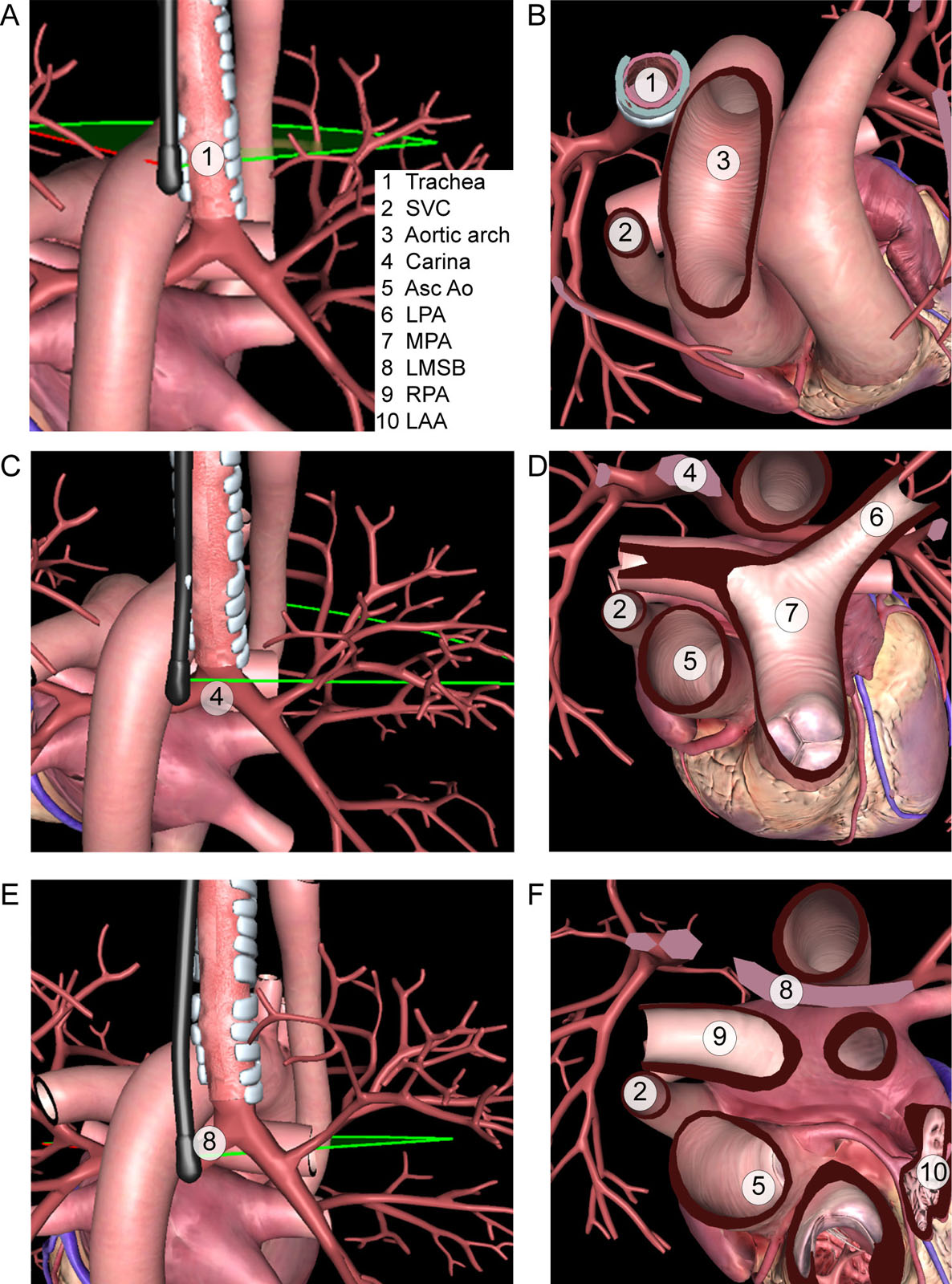 TEE blind spot. Interposition of the trachea (A,B), carina (C,D) and LMSB (E,F) anterior to the TEE probe creates blind areas where several cardiac structures (1 to 7) may not be identified clearly.<em> Abbreviations</em>: Asc Ao, ascending aorta; LAA, left atrial appendage; LMSB, left main stem bronchus; LPA, left pulmonary artery; MPA, main pulmonary artery; RPA, right pulmonary artery; SVC, superior vena cava; TEE, transesophageal echocardiography. Adapted from Sharma et al. <strong><sup>72</sup></strong>