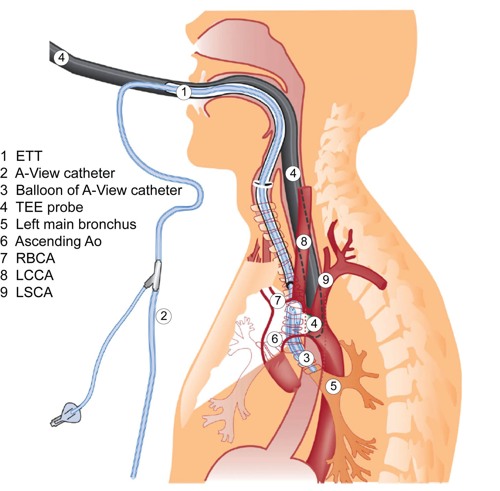 A-View balloon catheter. This sagittal cross-section view illustrates the anatomic relationship of structures with the A-View balloon catheter (DeRoyals, TN, USA), and TEE probe.<em> Abbreviations</em>: Ao, aorta; ETT, endotracheal tube; LCCA, left common carotid artery; LSCA, left subclavian artery; RBCA, right brachiocephalic artery; TEE, transesophageal echocardiography. Source: Adapted with permission from van Zaane et al.<sup>10</sup>