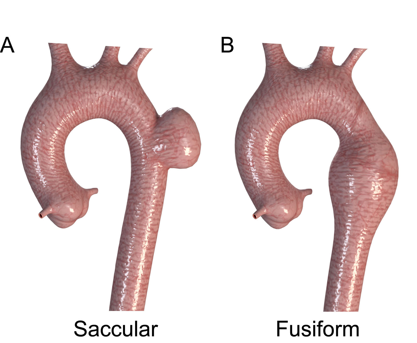Aneurysm morphology. (A,B) These diagrams illustrate the two morphologic types of aortic aneurysms, (A) saccular and (B) fusiform. Adapted from Isselbacher et al.<strong><sup>68</sup></strong>