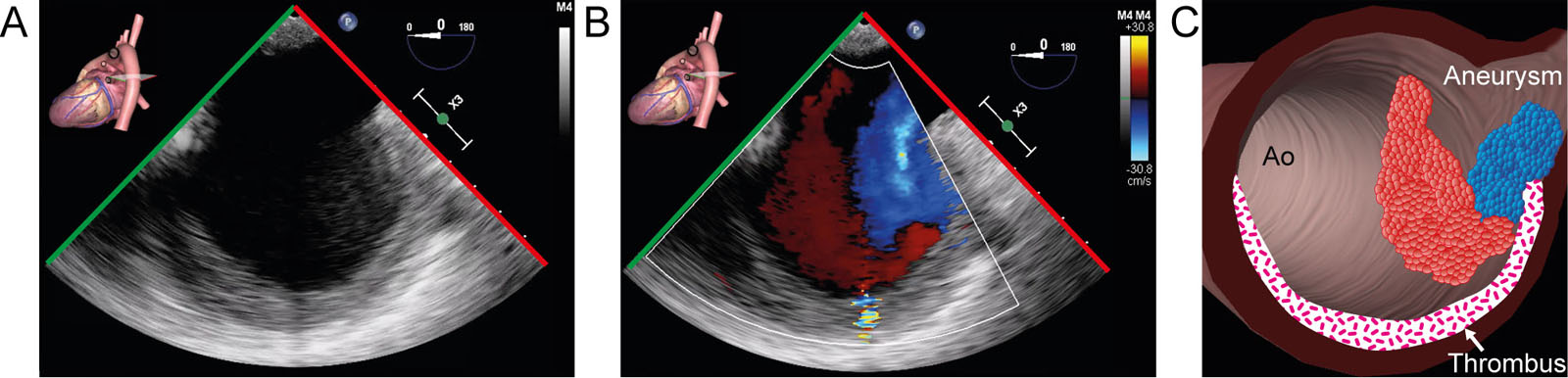 Saccular aneurysm. (A-C) Desc Ao SAX view with CFI shows a saccular aneurysm with a thrombus.<em> Abbreviations</em>: Ao, aorta; CFI, color flow imaging; Desc Ao, descending aorta; SAX, short-axis. <i class='fa fa-video-camera' aria-hidden='true'></i>