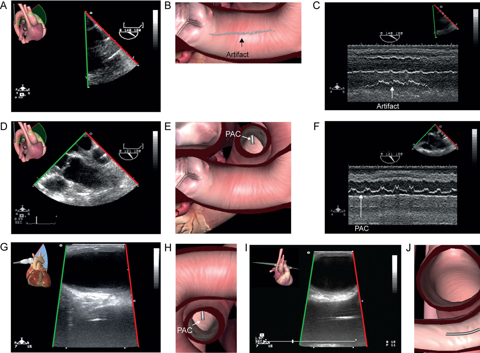 Pseudo-aortic dissection. A 57-year-old man undergoing coronary bypass surgery experiences problematic aortic cannula insertion, giving rise to suspicion of an aortic dissection. (A, B) ME Ao LAX view shows a mobile linear shadow suggestive of an intimal flap. (C) Corresponding M-mode of the suspected intimal flap (arrow) below the aortic wall. (D, E) ME Asc Ao LAX shows a PAC in the RPA. (F) On M-mode, the PAC motion (arrow) has an excursion quite like the suspected intimal flap. (G–J) Epiaortic scanning of the ascending Ao in G, H) LAX and (I, J) SAX fails to show a dissection flap, excluding an aortic dissection. The linear shadow represents a reverberation artifact in the aorta from the PAC in the RPA.<em> Abbreviations</em>: Ao, aorta; Asc Ao, ascending aorta; LAX, long-axis; ME, mid-esophageal; PAC, pulmonary artery catheter; RPA, right pulmonary artery; SAX, short-axis. <i class='fa fa-video-camera' aria-hidden='true'></i>