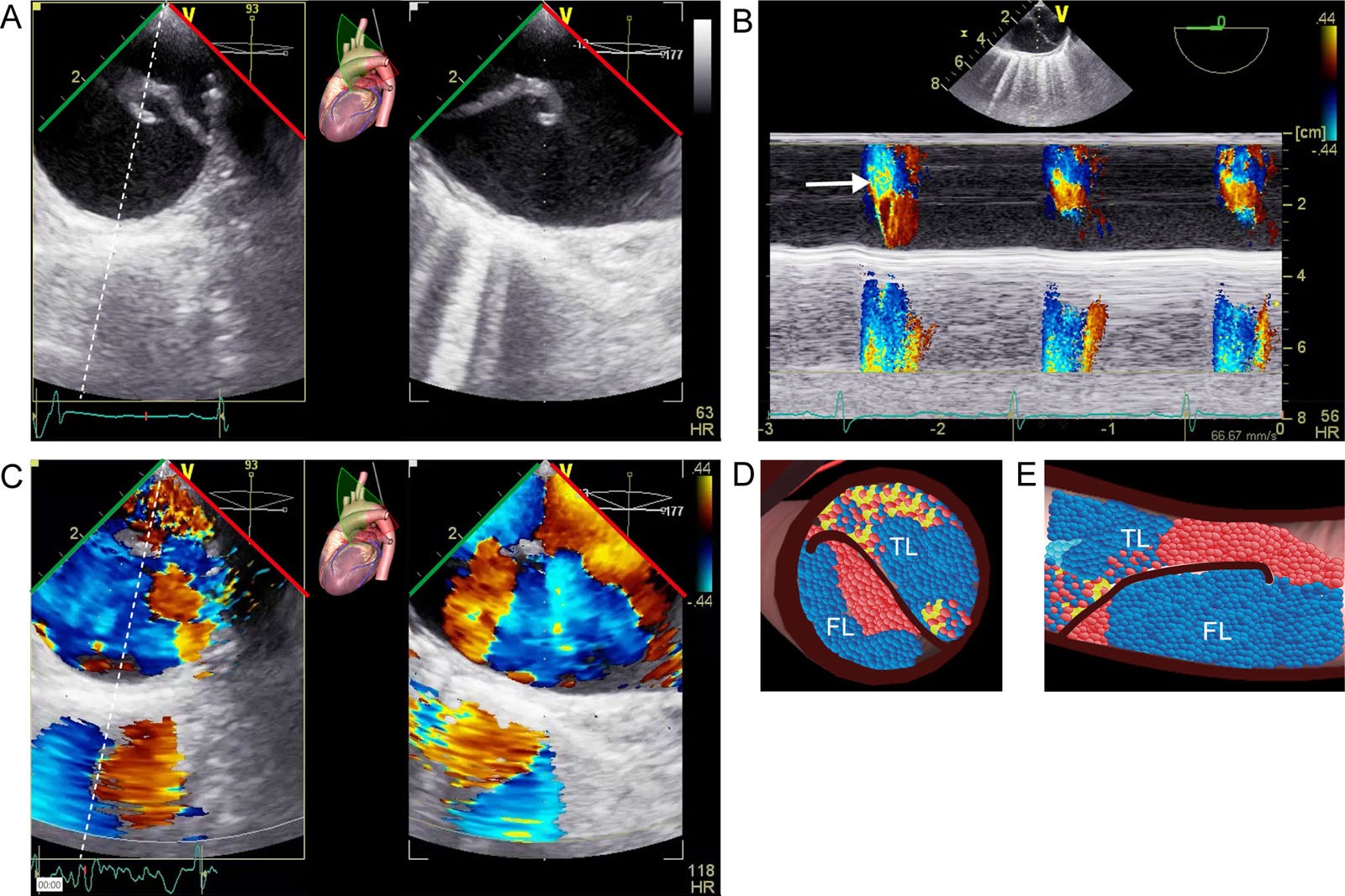 Aortic dissection Stanford type A. (A) Biplane ME Desc Ao SAX view shows the TL has a smaller diameter and is more pulsatile compared with the FL. (B) Color M-mode can help identify the TL where most systolic aliasing occurs versus FL. (C-E) Biplane ME AoV SAX view with CFI shows flow in both the TL and FL.<em> Abbreviations</em>: AoV, aorta valve; CFI, color flow imaging; Desc Ao, descending aorta;FL, false lumen; ME, mid-esophageal; SAX, short-axis; TL, true lumen. <i class='fa fa-video-camera' aria-hidden='true'></i>