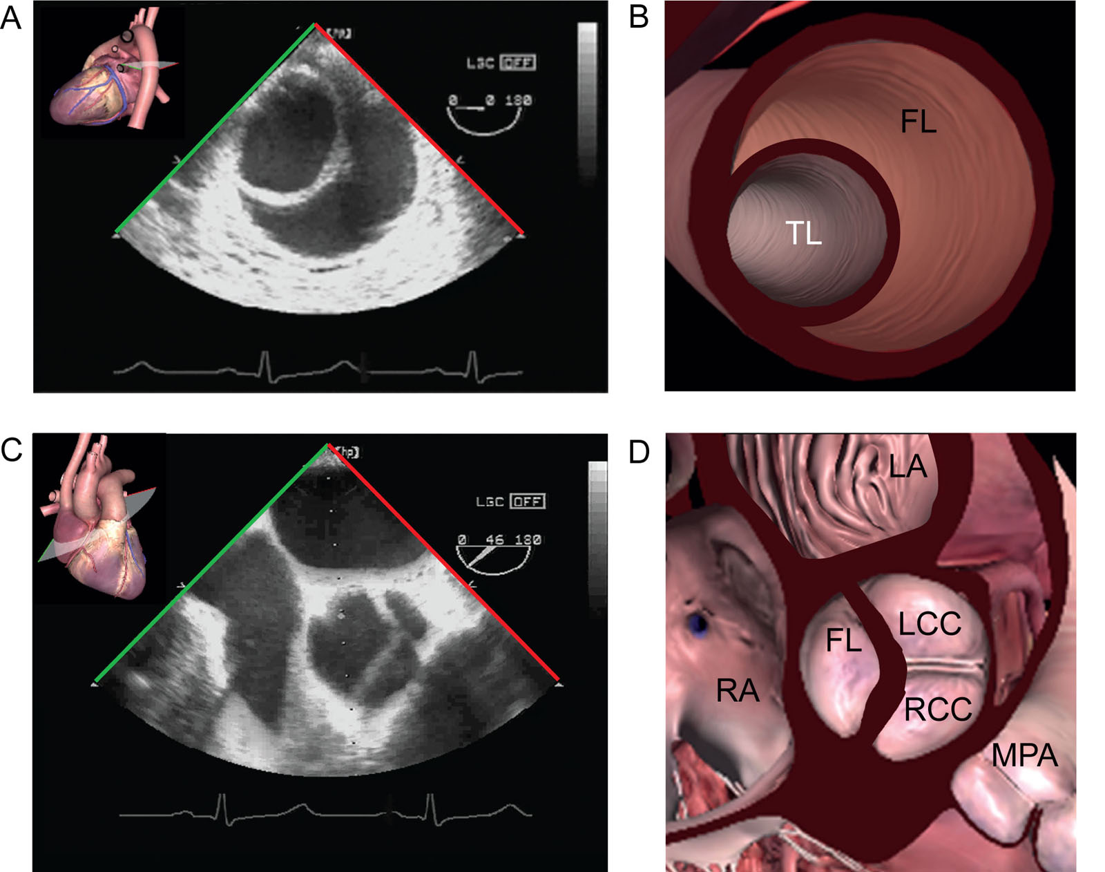Aortic dissection Stanford type A. (A, B) ME descending aorta SAX view shows the TL has a smaller diameter and is more pulsatile compared with the FL. (C, D) ME AoV SAX view shows a proximal extension of the intimal flap to the level of the sinuses of Valsalva above the AoV.<em> Abbreviations</em>: AoV, aorta valve; FL, false lumen; LA, left atrium; LCC, left coronary cusp; ME, mid-esophageal; MPA, main pulmonary artery; RA, right atrium; RCC, right coronary cusp; SAX, short-axis; TL, true lumen. <i class='fa fa-video-camera' aria-hidden='true'></i>